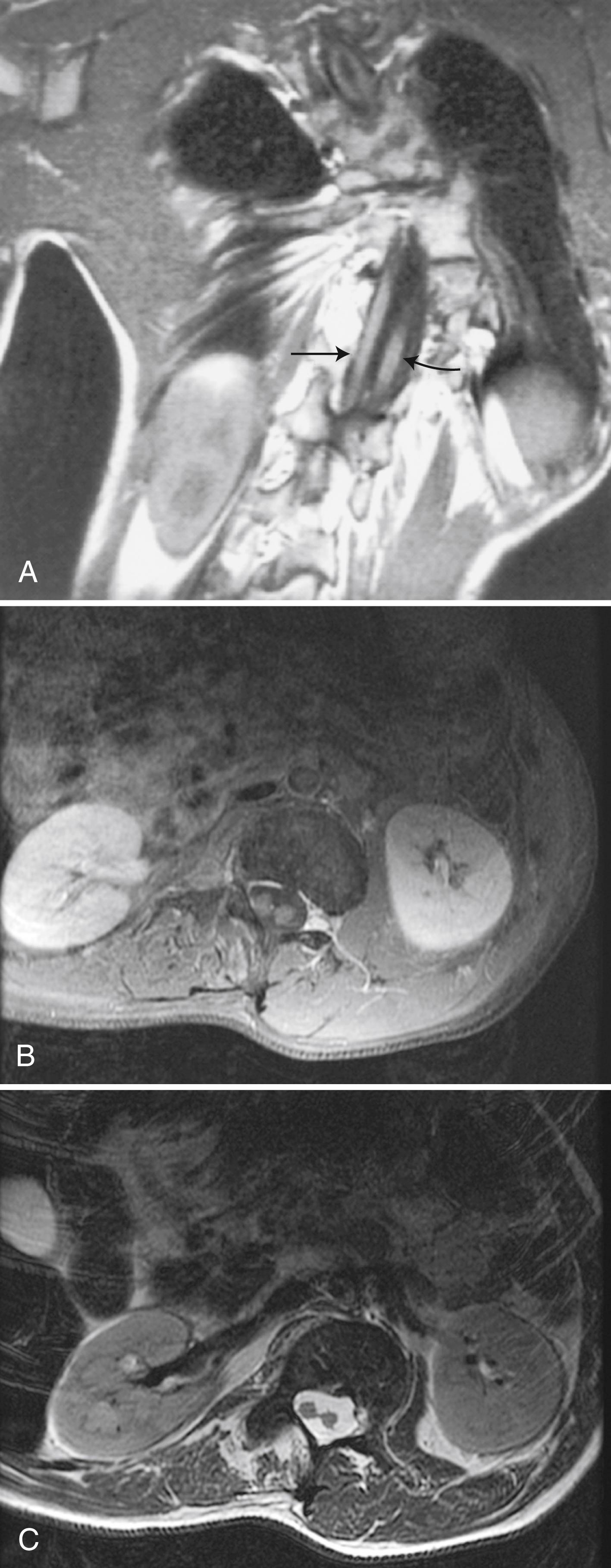 eFig. 104.13, Magnetic Resonance Images of Diastematomyelia.