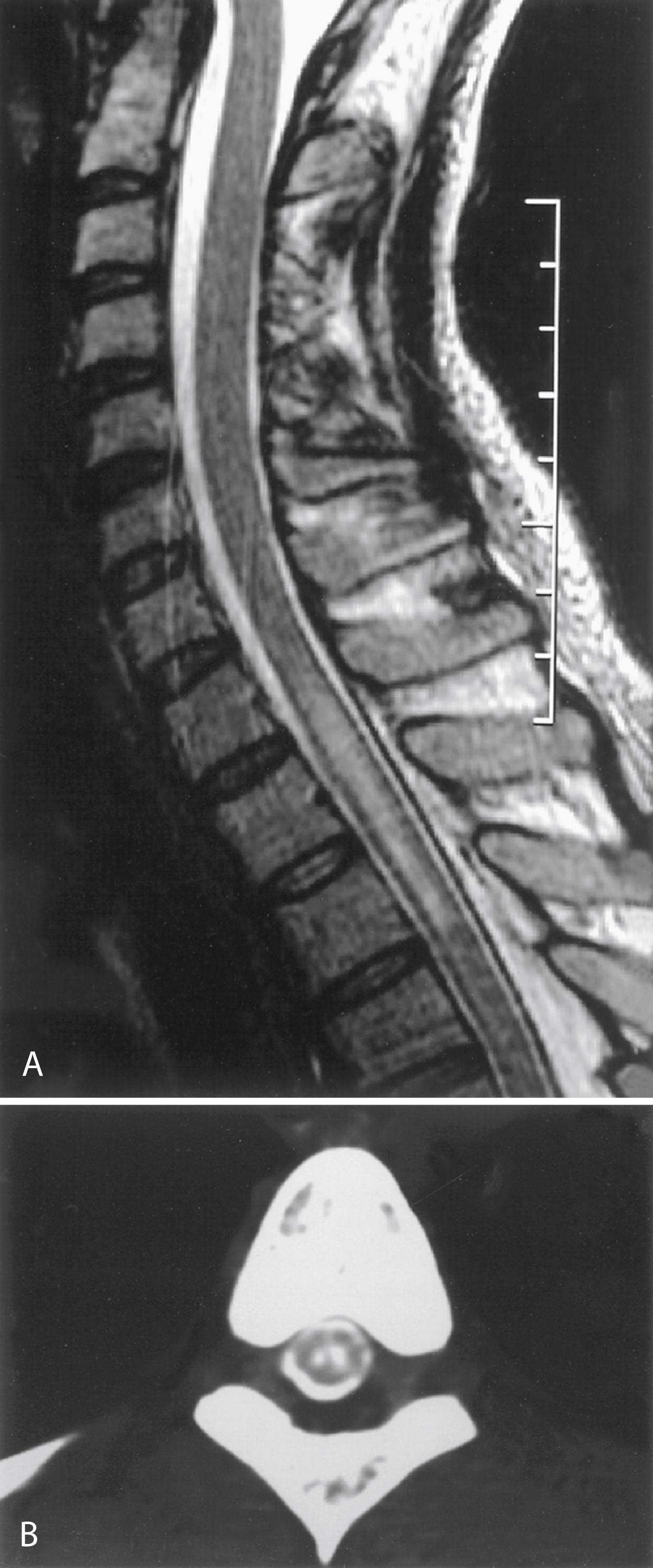 Fig. 104.15, A, Sagittal T2-weighted magnetic resonance imaging demonstrates intramedullary signal abnormality posterior to T1–T3 level of spinal cord. Possible causes include edema, myelomalacia, or syringomyelia. B, Axial computed tomographic myelogram performed at a 3-hour delay demonstrates filling of area of signal abnormality with myelographic contrast that had been injected into lumbar subarachnoid space. Filling of cavity with contrast is consistent with syringomyelia but would not be expected in cases of cord edema or myelomalacia.