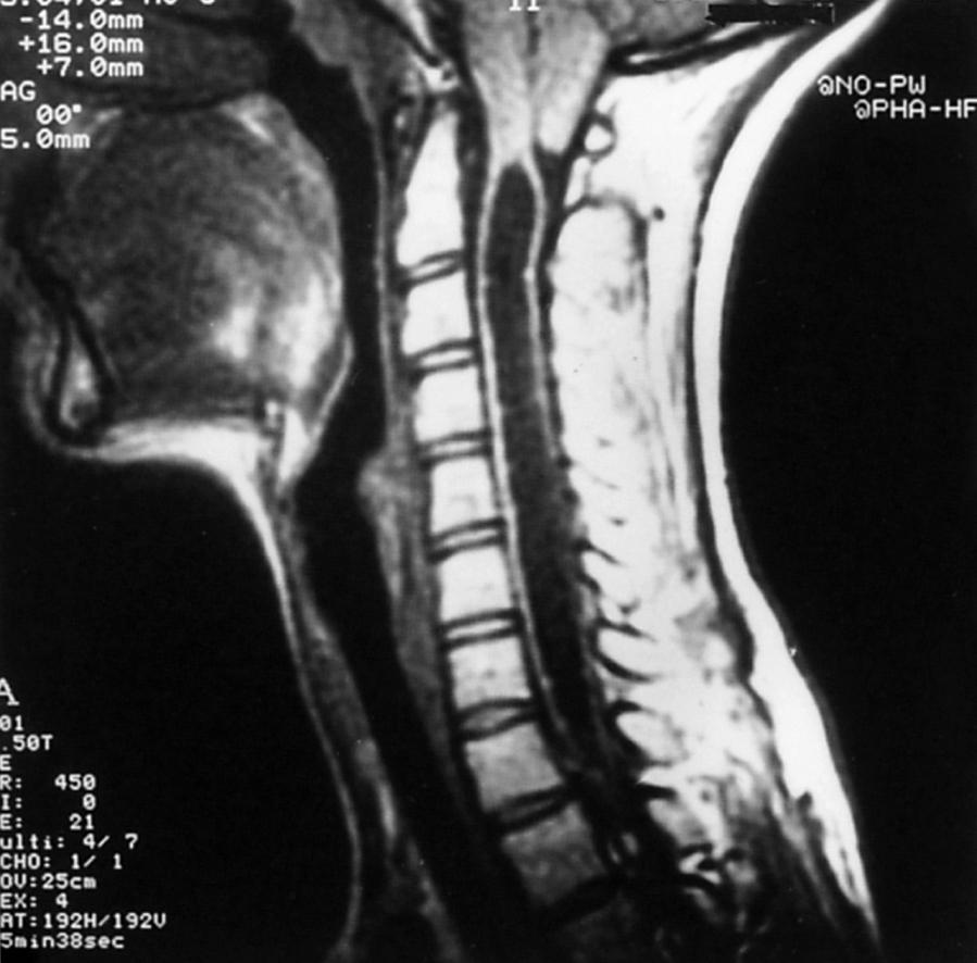 Fig. 104.16, Magnetic resonance image demonstrates a large syringomyelic cavity in the cervical cord.