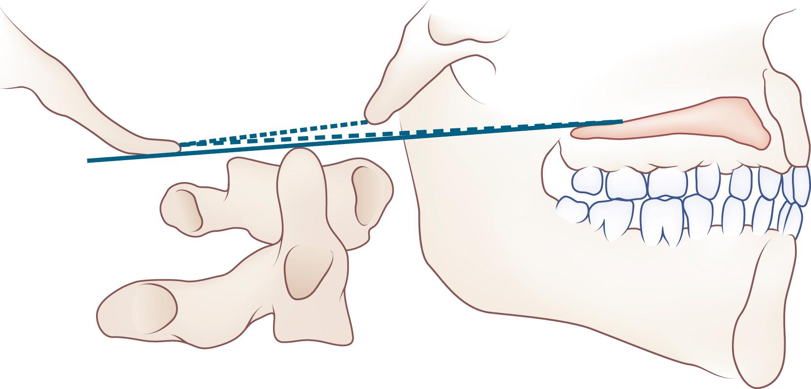 eFig. 104.3, Chamberlain line (dashes) extends from roof of hard palate to posterior lip of foramen magnum; McGregor line (solid) extends from roof of hard palate to most caudal portion of occipital bone; McRae line (dots) extends from anterior lip of foramen magnum to posterior lip of foramen magnum. Tip of odontoid is normally not more than 5 mm above McGregor line and not above Chamberlain or McRae line.