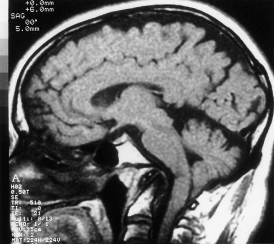 eFig. 104.4, Magnetic Resonance Image of Patient With Basilar Impression, Showing Brainstem Angulation.