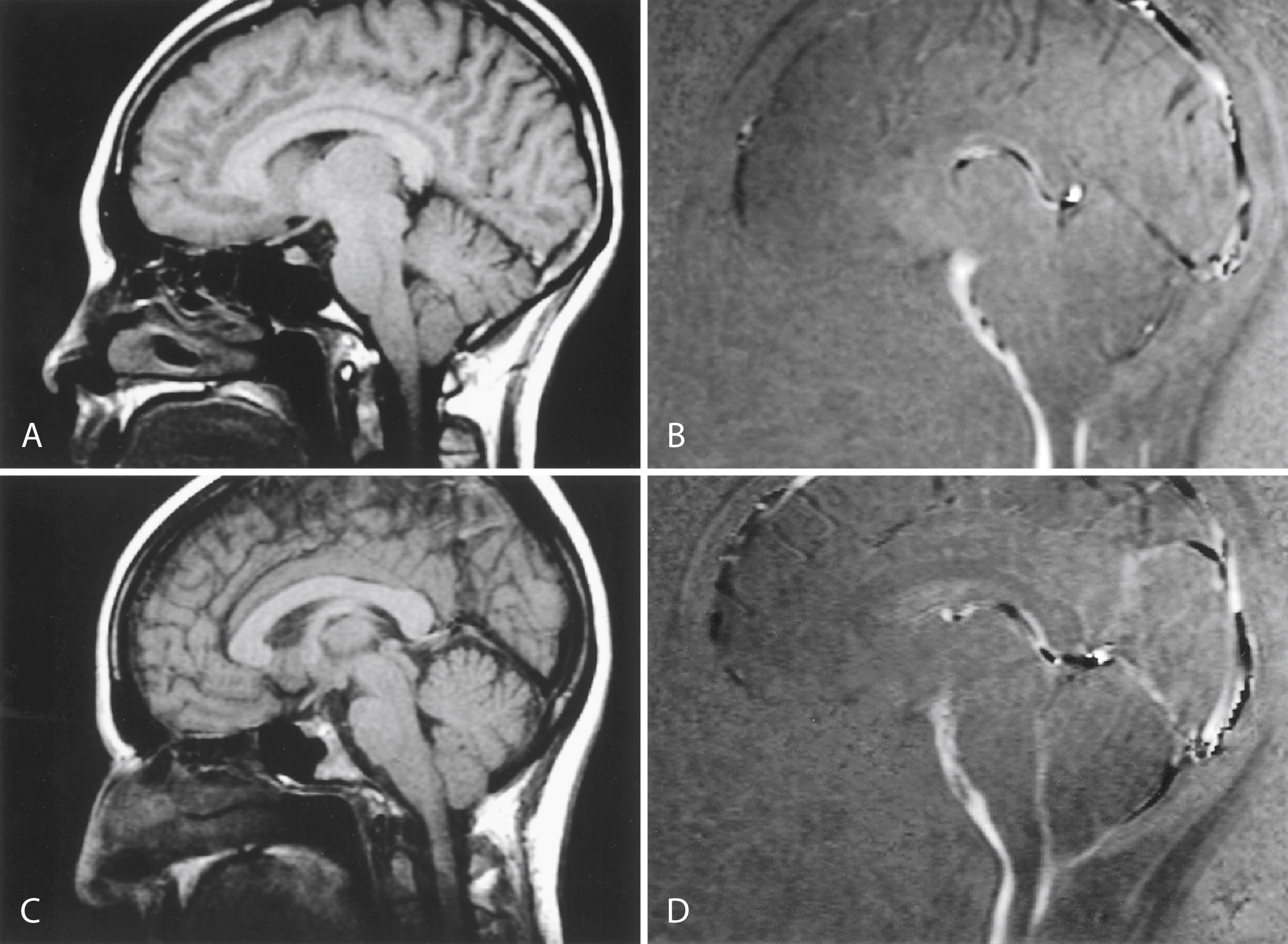Fig. 104.6, A, Sagittal magnetic resonance imaging (MRI) scan of a patient with Arnold-Chiari type I malformation. Midline T1-weighted image demonstrates low cerebellar tonsils, 8 mm below foramen magnum. B, MRI cerebrospinal fluid (CSF) flow study of same patient demonstrates diminished flow signal at cerebellar tonsils, indicative of CSF flow propagation abnormality. Note normal CSF flow signal below tonsils and anterior to brainstem. C, Sagittal MRI of a patient with low-lying cerebellar tonsils at 6 mm below foramen magnum. D, CSF flow study demonstrating normal flow signal at level of cerebellar tonsils, indicative of normal propagation of CSF flow through foramen magnum.