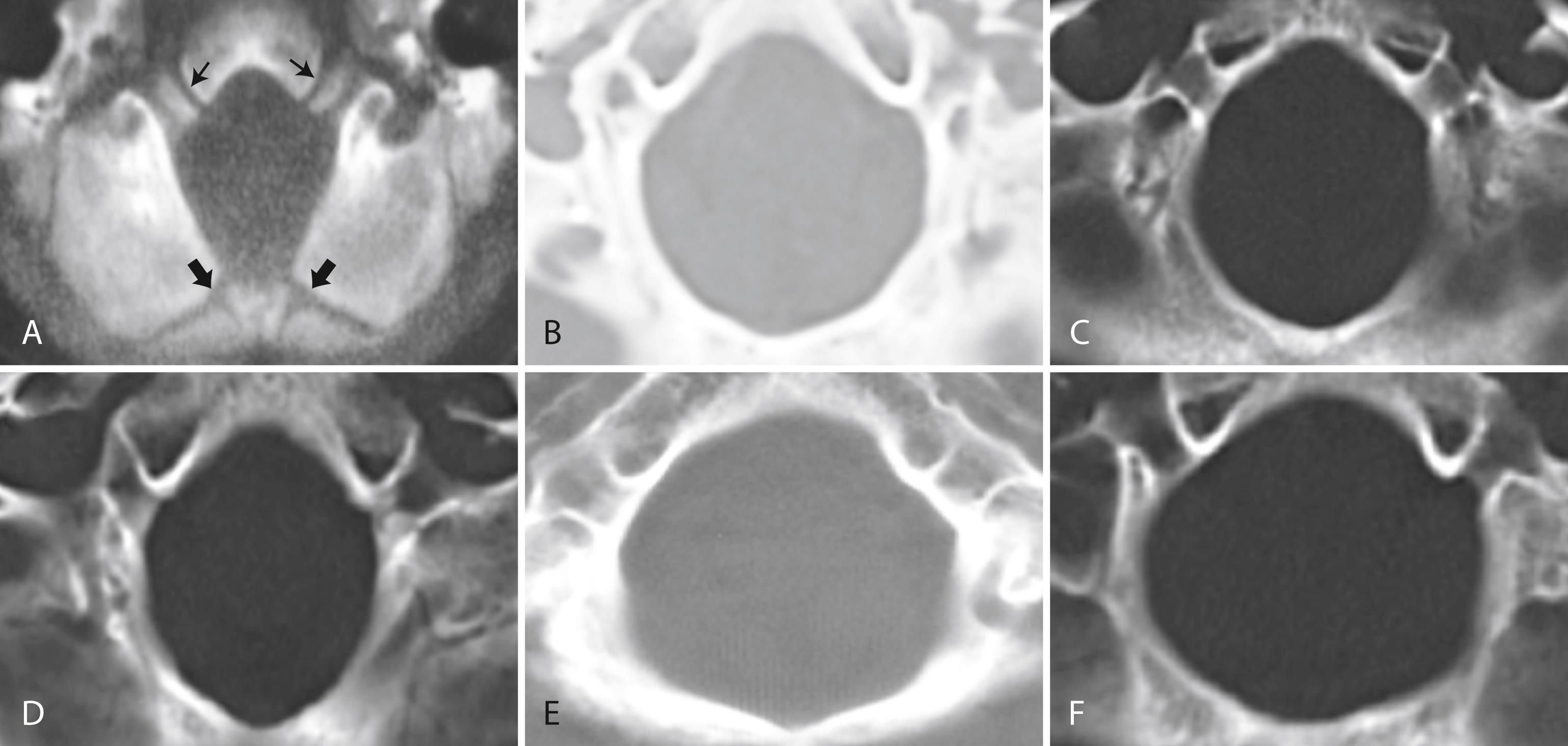 Fig. 104.7, Morphometric Assessments of Foramen Magnum at Level of Superior Outlet Using Axial Computed Tomography Images.