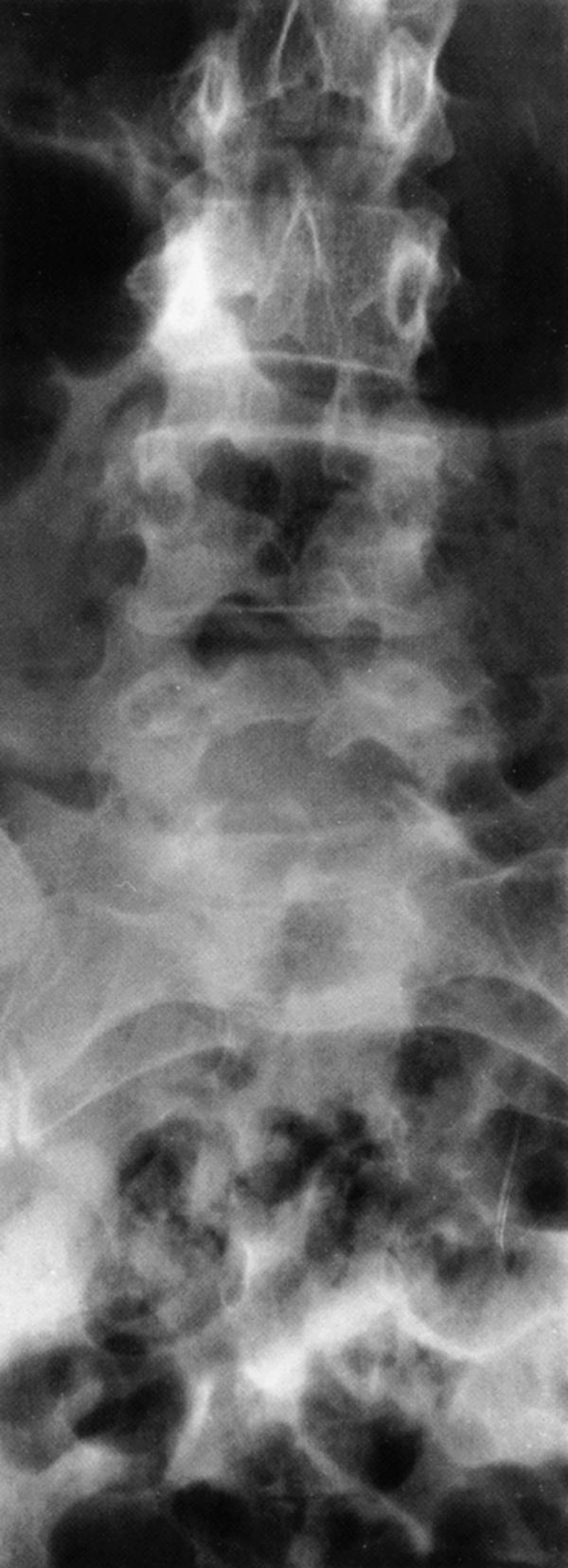 eFig. 104.8, Lumbar Spine Radiograph Shows Spina Bifida Occulta.