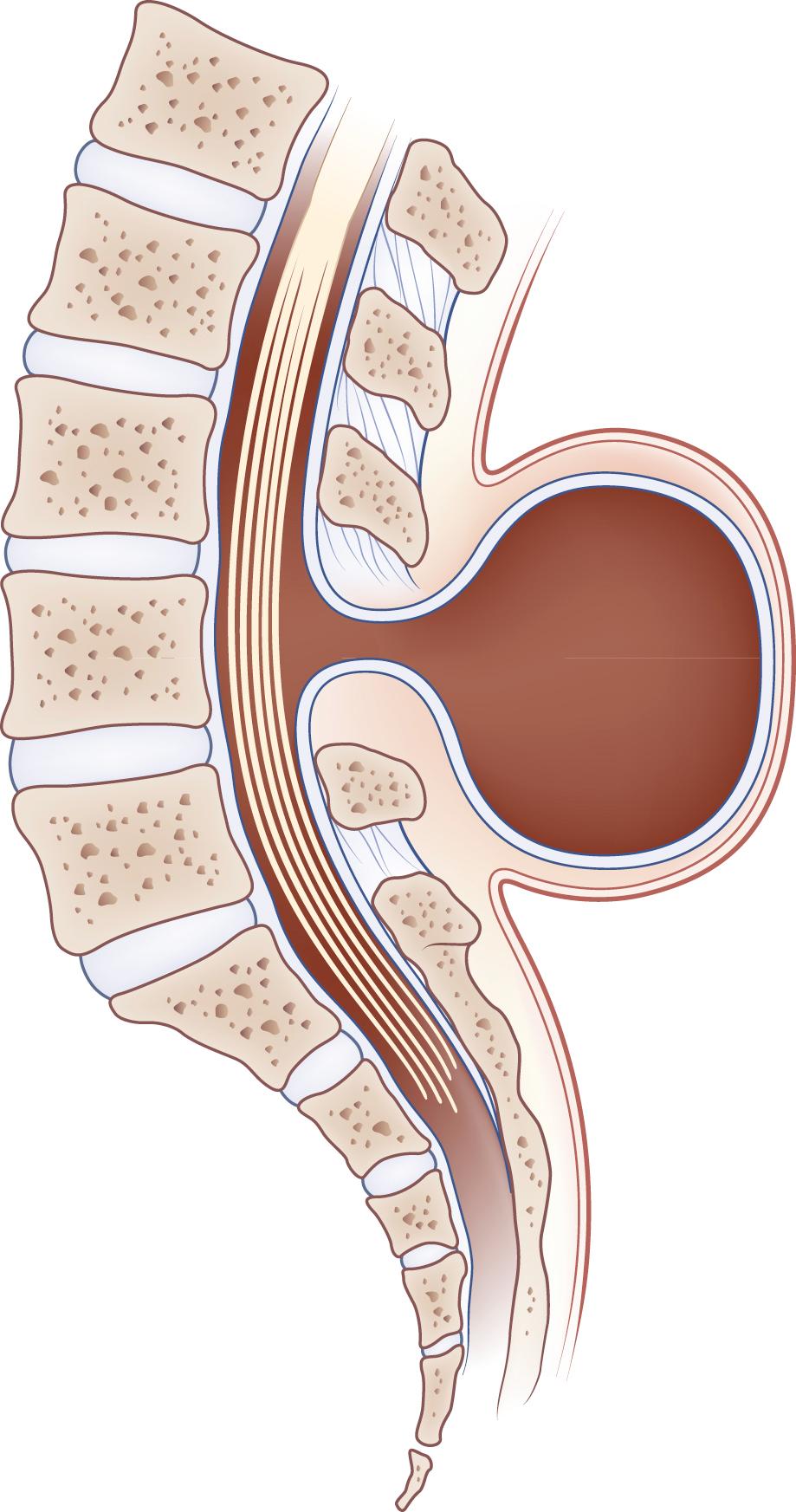 Fig. 104.11, Diagrammatical Representation of Meningocele.