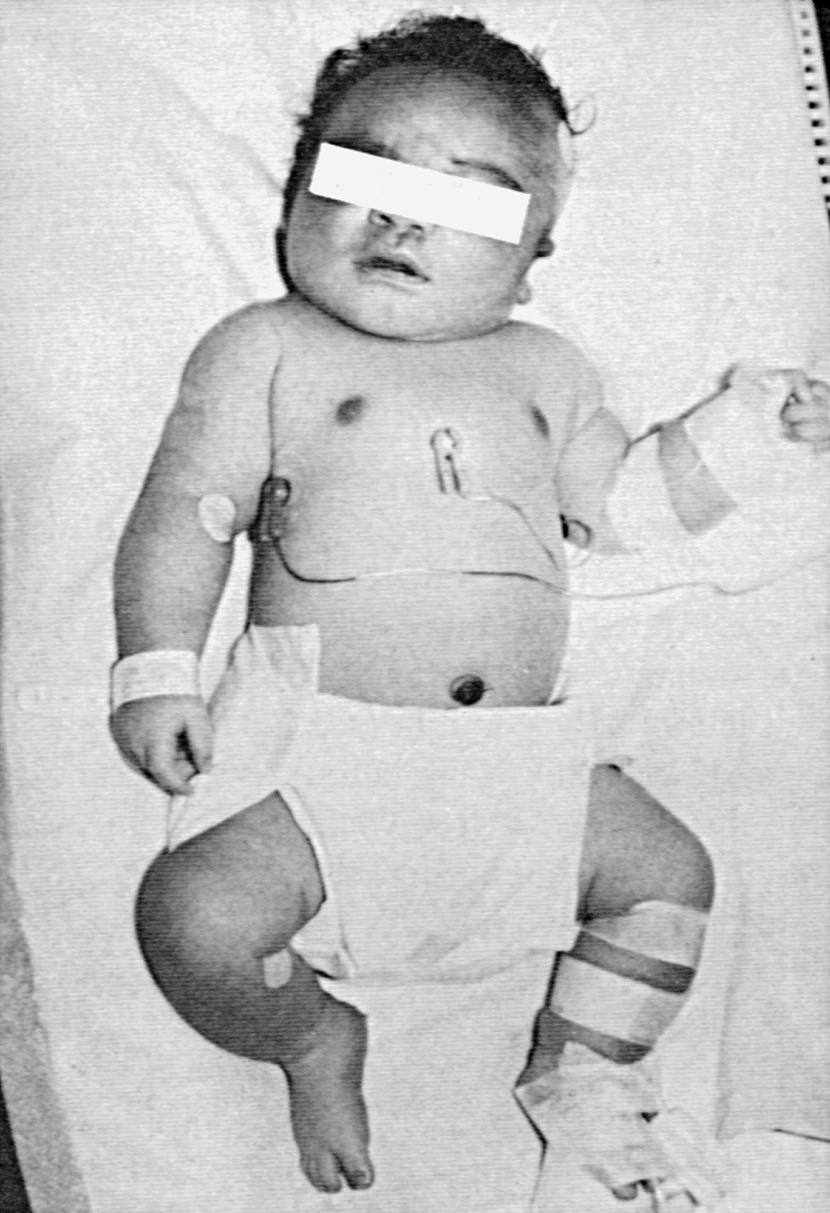 Fig. 86.5, Infant of mother with gestational diabetes; the baby was born at 40 weeks of gestation with a birth weight of 4.6 kg. The infant developed hypoglycemia and was treated with intravenous glucose.