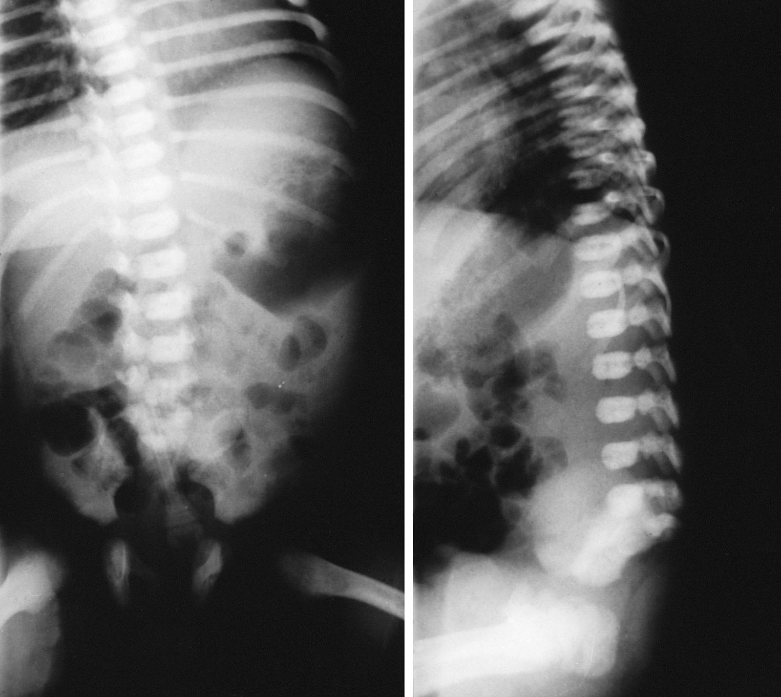 Fig. 86.6, Anteroposterior ( left ) and lateral ( right ) radiographs of sacral agenesis in an infant of a diabetic mother.