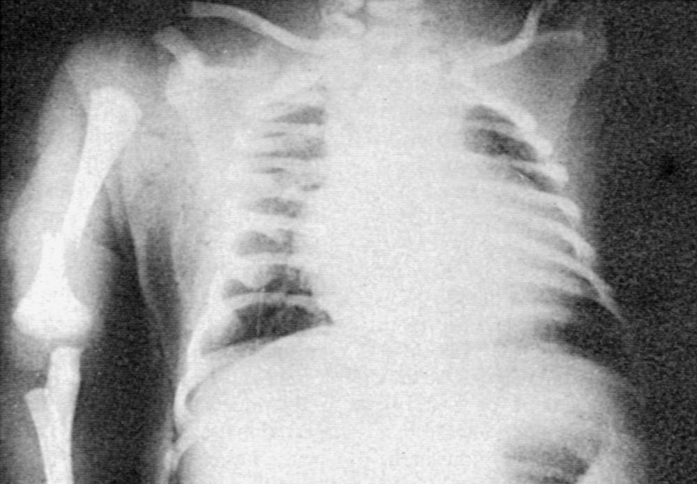 Fig. 86.7, Chest radiograph of a vaginally delivered, full-term infant (4.7 kg) of a diabetic mother. The infant had cardiomegaly, hepatomegaly, congested lung fields, and fractures of the right humerus and left clavicle.