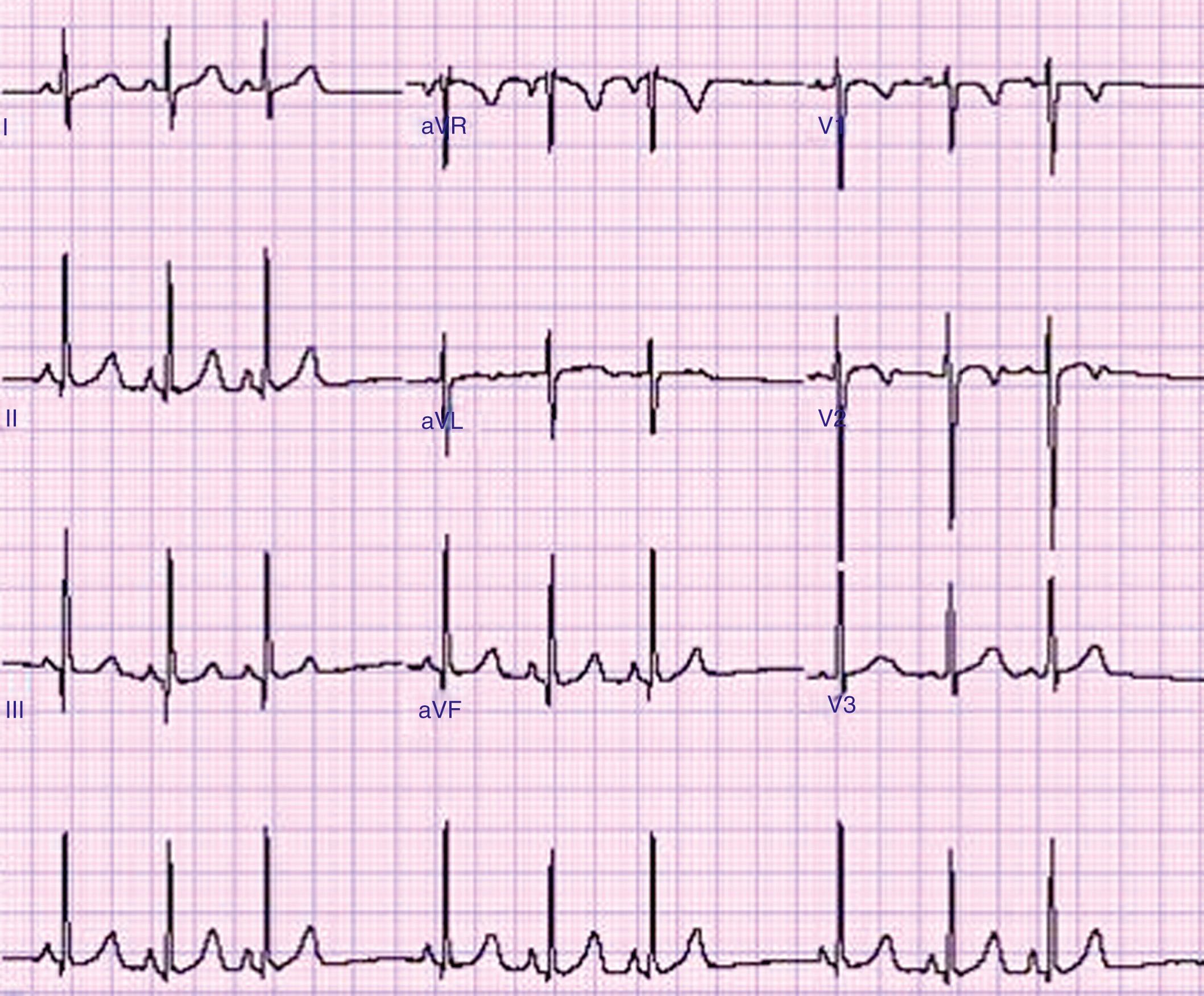 Fig. 77.1, Sinus arrhythmia in a healthy child. Note that all P waves look exactly the same, although there is marked variation in their rate.