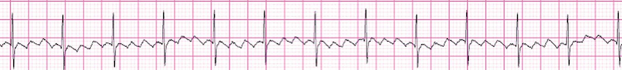 Fig. 77.2, Atrial flutter with 4 : 1 AV conduction in a 1-day-old newborn.