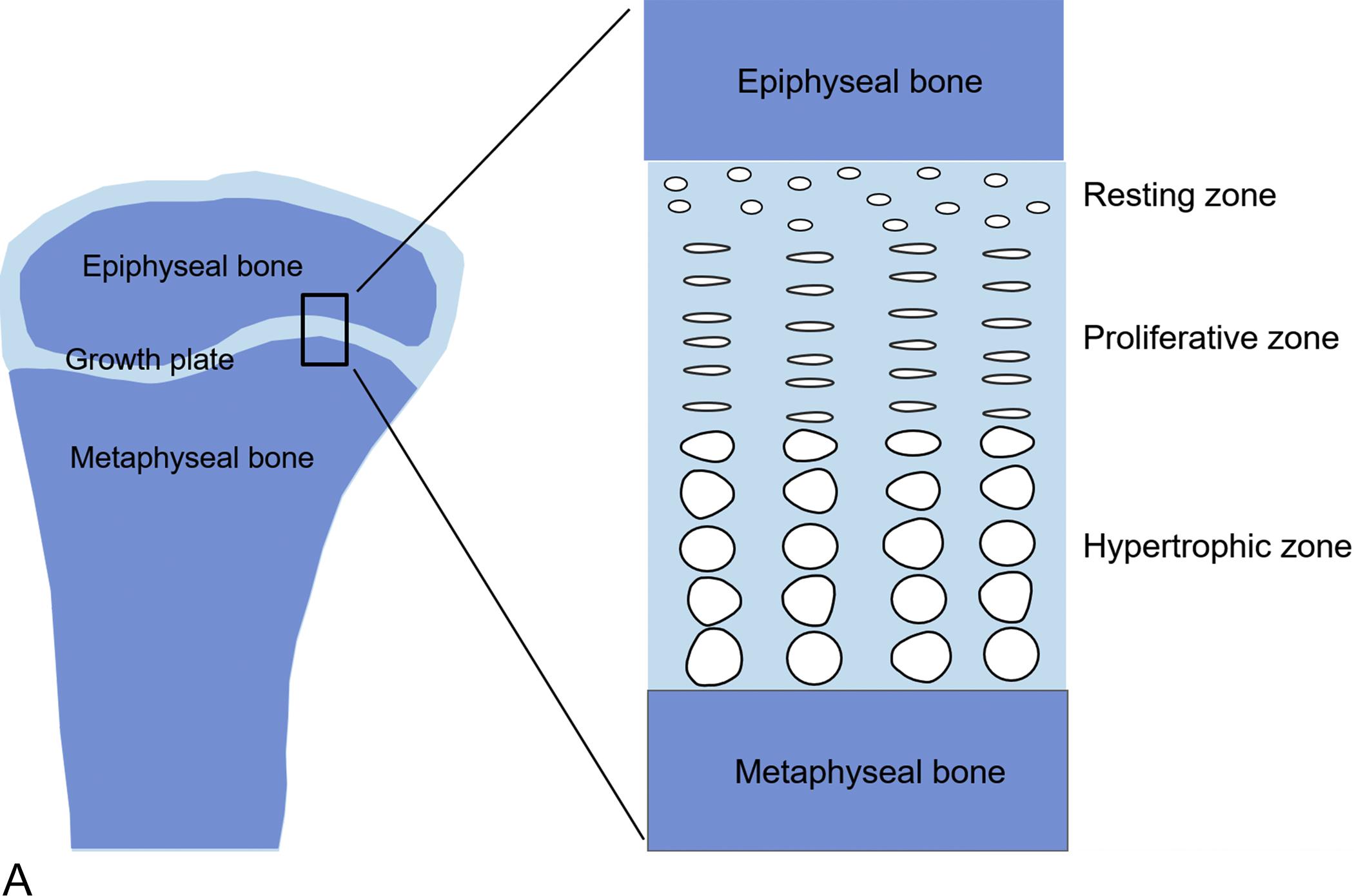 Fig. 11.1A, Growth plate structure. In children, linear growth (height gain) results from growth plate chondrogenesis. The growth plate is a thin layer of cartilage found near the ends of long bones and in vertebrae. The growth plate is composed of three zones.