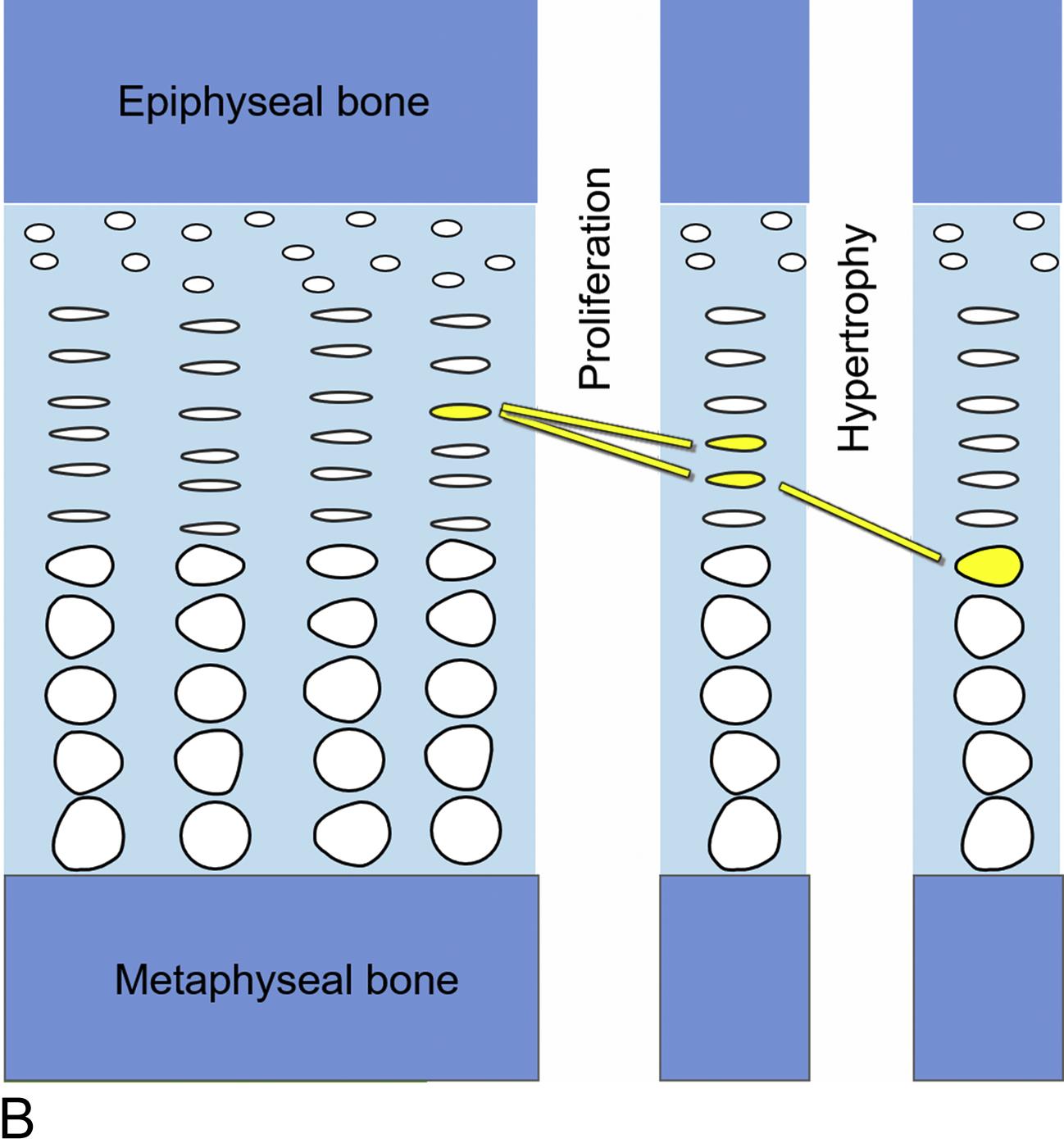 Fig. 11.1B, Growth plate function. Within the growth plate, chondrocytes first proliferate and later hypertrophy. The result is the production of more cartilage (chondrogenesis). At the bottom of the growth plate, the newly formed cartilage is remodeled into bone (not shown). The net result is that new bone is created at the bottom of the growth plate, gradually pushing apart the ends of the bone, causing the bones to grow longer and the child to grow taller.