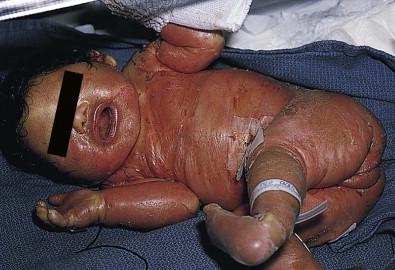 Figure 19.1, Shiny collodion membrane of a 1-day-old collodion baby. Note the eclabion and tightened skin of the hands.