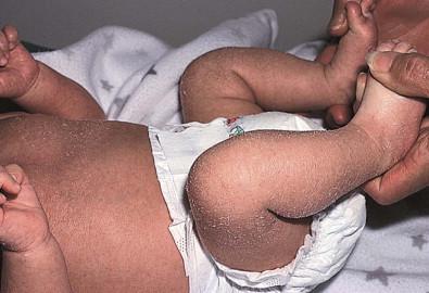 Figure 19.3, Diffuse scaling of the trunk and extremities is seen in this 2-week-old infant with X-linked ichthyosis.