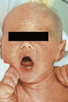 Figure 19.6, A 32-day-old infant with failure to thrive, hypernatremic dehydration, and ichthyosiform erythroderma was diagnosed with Netherton syndrome by microscopic examination of one of just a few sparse hairs. Note the sparse hair secondary to trichorrhexis invaginata. The infant died of sepsis at 3 months of age.