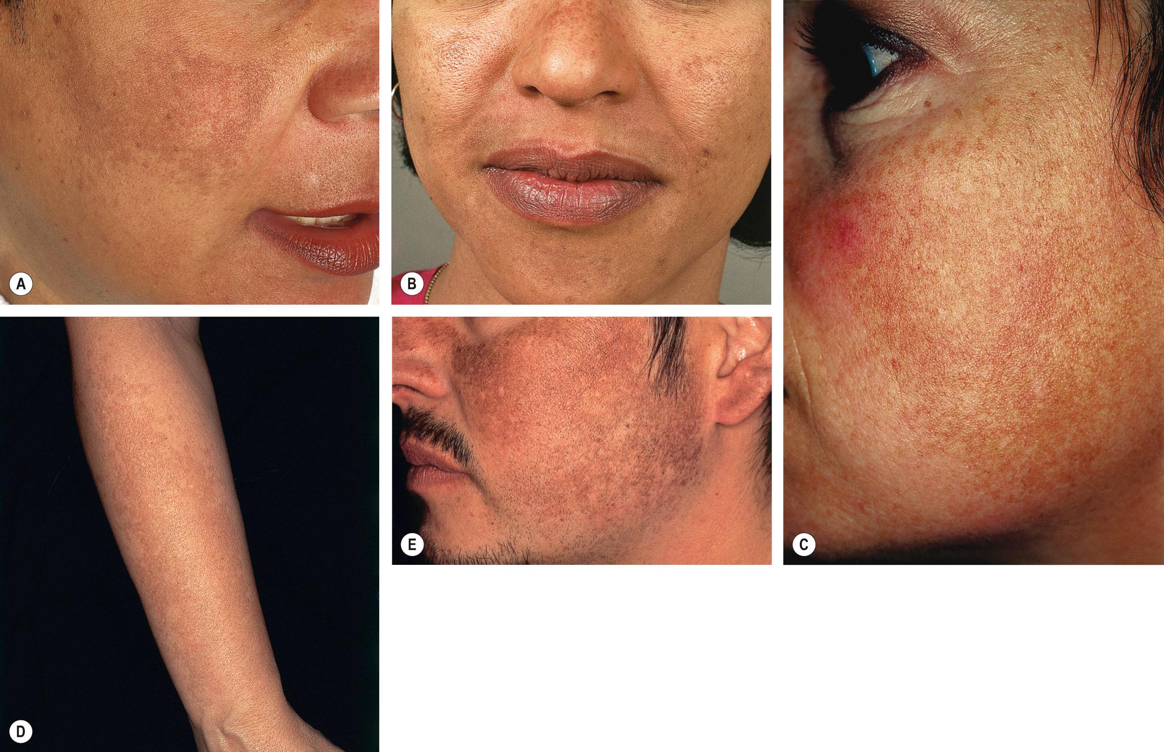 Fig. 67.5, Various forms of melasma and melasma-like hyperpigmentation.