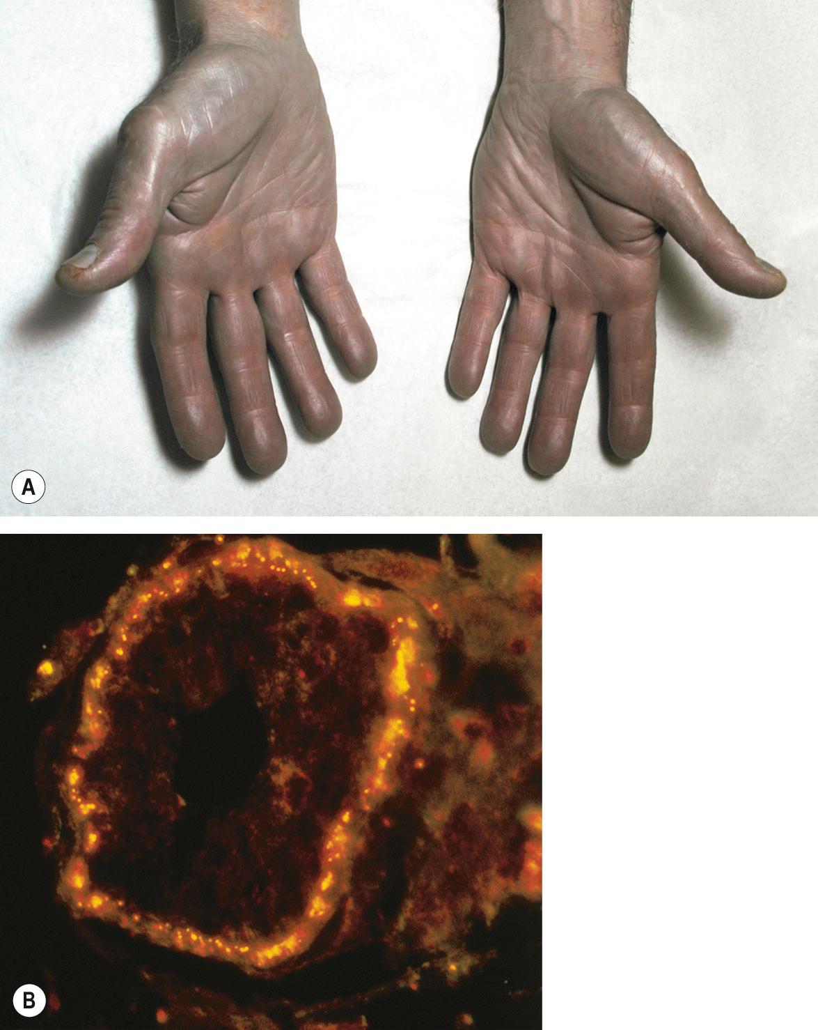 Fig. 67.7, Argyria.