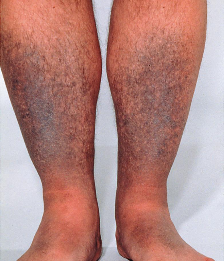 Fig. 67.9, Minocycline-induced pigmentation.