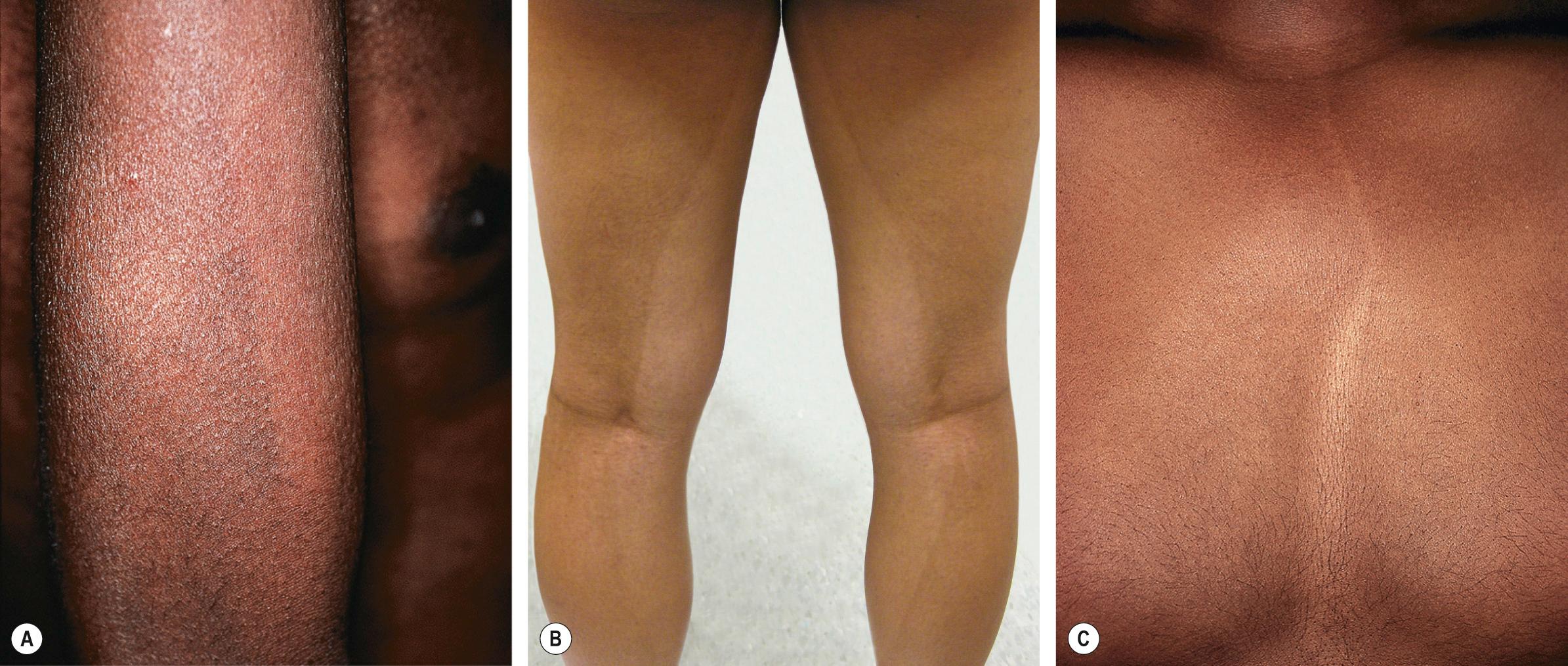 Fig. 67.11, Pigmentary demarcation lines (PDLs).