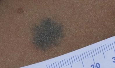 Figure 24.6, Typical-appearing blue nevus.