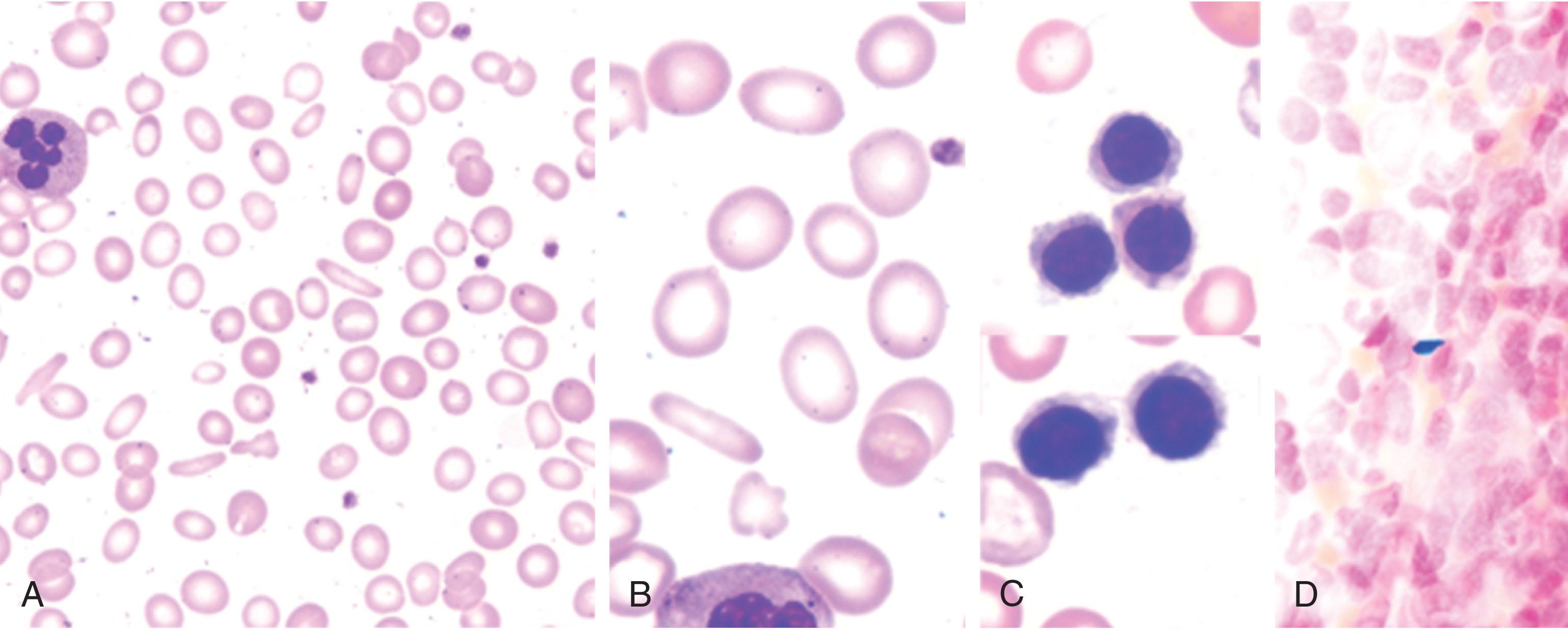 Figure 37.2, IRON DEFICIENCY ANEMIA.