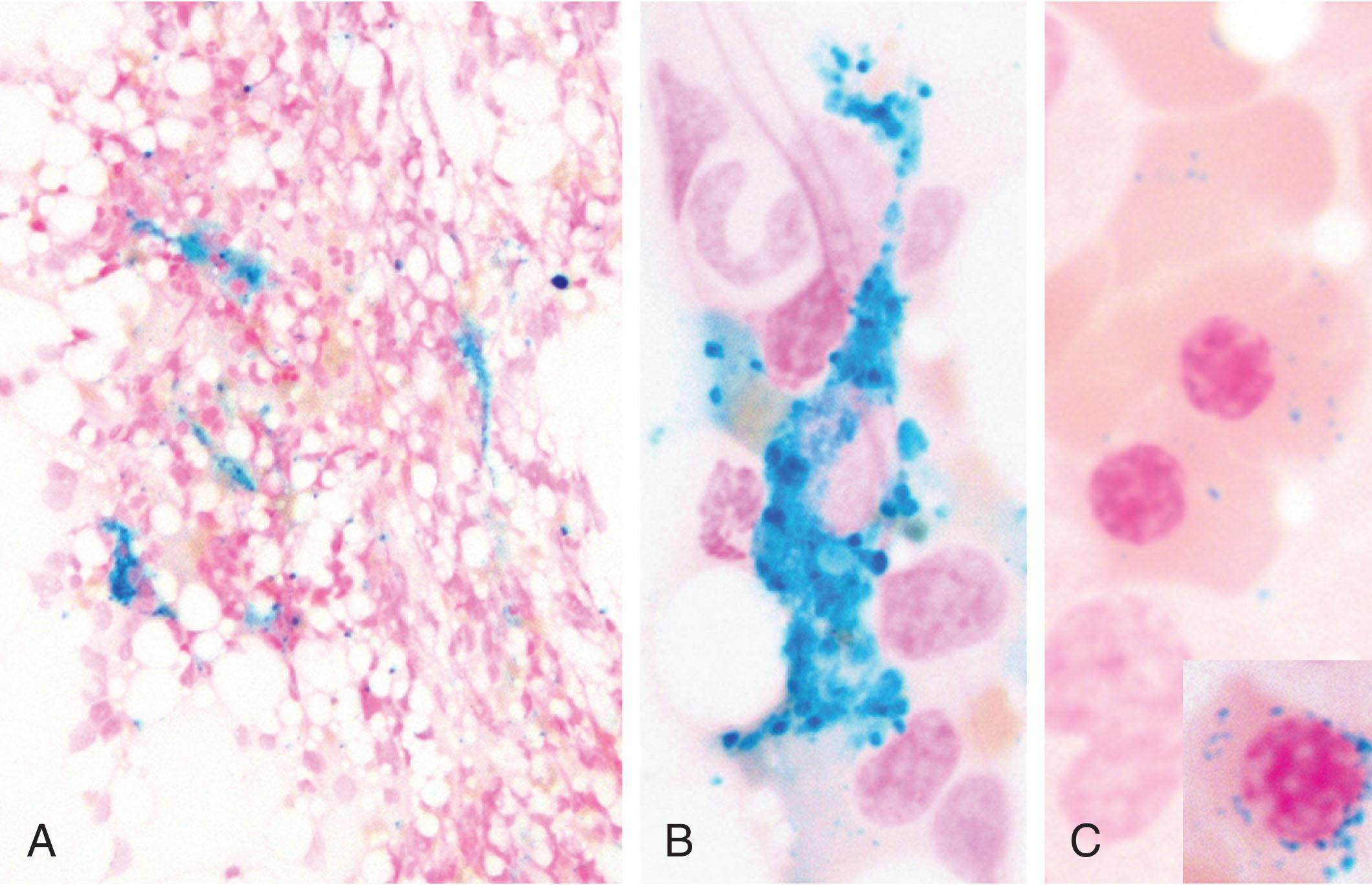 Figure 37.3, ASSESSMENT OF IRON STORES ON A BONE MARROW ASPIRATE.