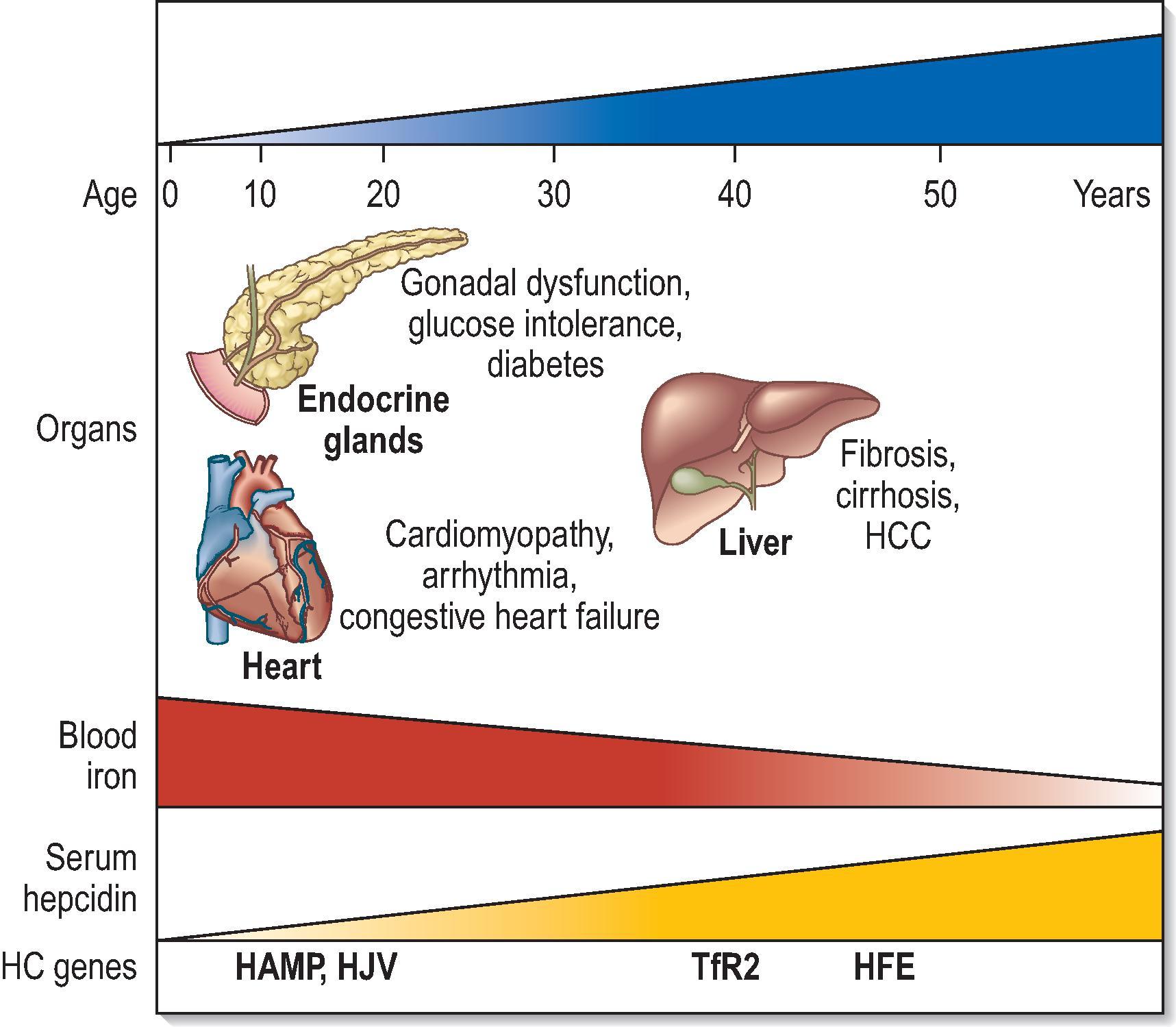 Figure 4.2, The common genetic basis and phenotypic continuum of haemochromatosis (HC). The basic features of hereditary HC can be produced by pathogenic mutations of a number of iron metabolism genes ( HJV , HAMP , TfR2 , FPN and HFE ). Depending on the gene involved and its role in hepcidin biology, the HC phenotype varies. If the altered gene plays a dominant role in hepcidin synthesis (e.g. HAMP itself or HJV ), circulatory iron overload occurs rapidly and reaches high levels. In these cases, the clinical presentation will invariably be dramatic, with early onset (1st to 2nd decade) of full-blown organ disease (particularly affecting the heart and endocrine glands). If the gene (e.g. HFE ) is less critical to this process, a milder late-onset phenotype will arise. This continuum also includes ‘intermediate phenotypes’ (e.g. those caused by pathogenic mutations of TfR2 or by rare combinations of mutations). HCC , Hepatocellular carcinoma. From Pietrangelo A. Hereditary hemochromatosis: pathogenesis, diagnosis, and treatment. Gastroenterology. 2010;139:393–408.