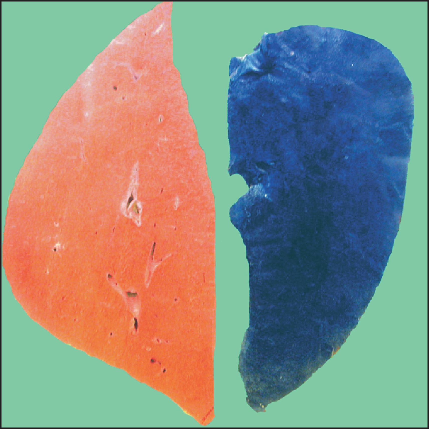 Figure 4.3, Postmortem liver from a patient with hereditary haemochromatosis. The liver has an orange-brown colour that, when dipped in Perls solution, demonstrates the characteristic Prussian-blue reaction.