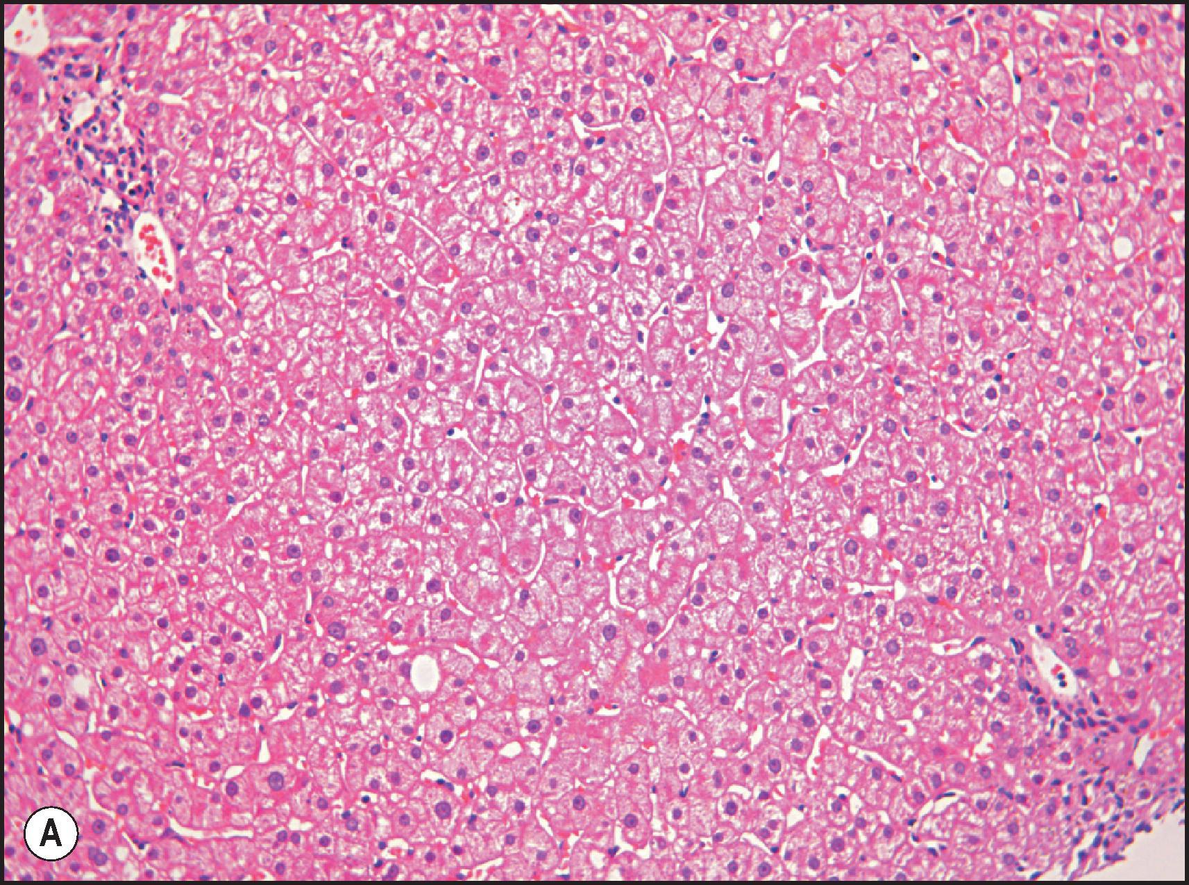 Figure 4.4, Male of 38 years with deranged liver function tests. He was subsequently identified as homozygous for the C282Y mutation on the basis of the biopsy finding. (A) Liver biopsy is histologically unremarkable on routine staining. (Haematoxylin and eosin [H&E] stain.) (B) However, grade 1 iron deposition is present in periportal hepatocytes. (Perls stain.)