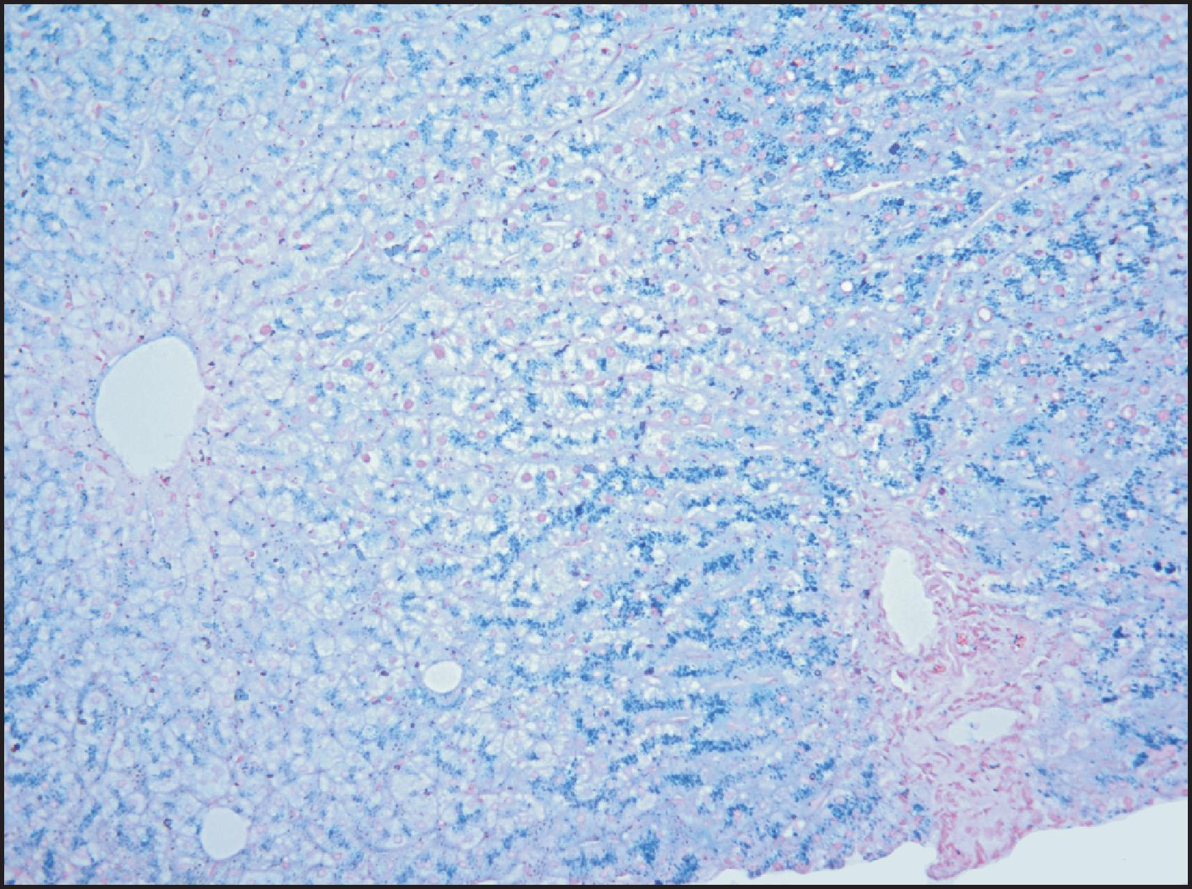 Figure 4.5, Male of 45 years homozygous for C282Y with abnormal liver function tests and grade 3 iron overload. A hepatic iron gradient is still evident. (Perls stain.)