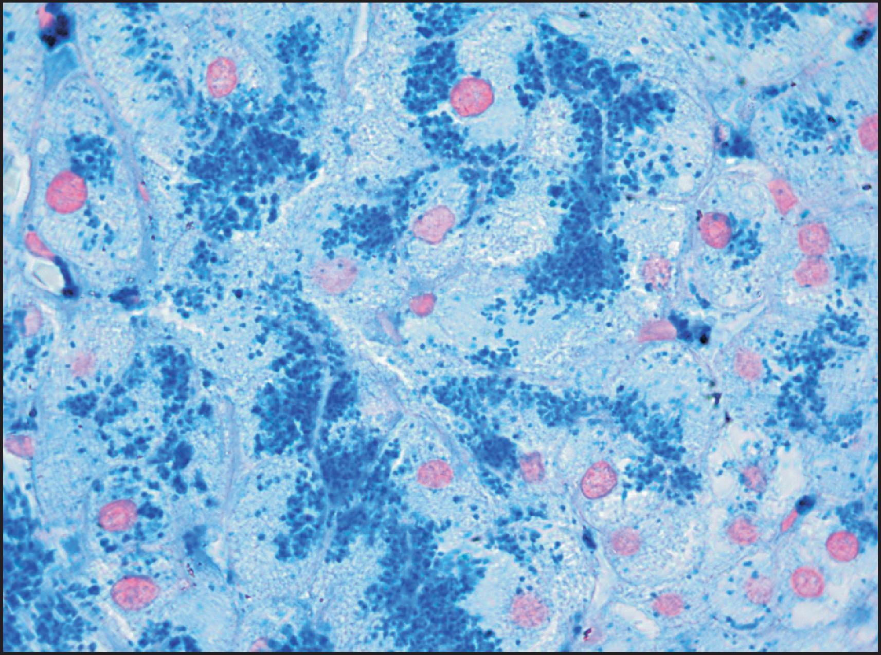 Figure 4.6, The pericanalicular pattern of iron distribution is typical for hereditary haemochromatosis but is not specific. (Perls stain.)