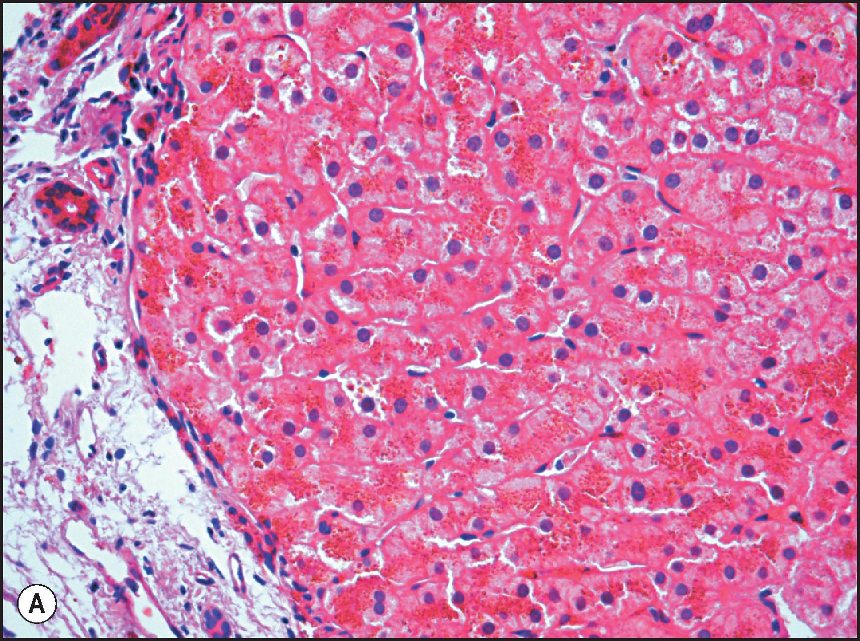 Figure 4.7, C282Y homozygote with haemochromatosis and cirrhosis. (A) Iron accumulation can be appreciated on H&E staining. (B) Note the loss of the gradient pattern and marked iron overload. The bile duct (arrow) also has iron deposition. (Perls stain.)