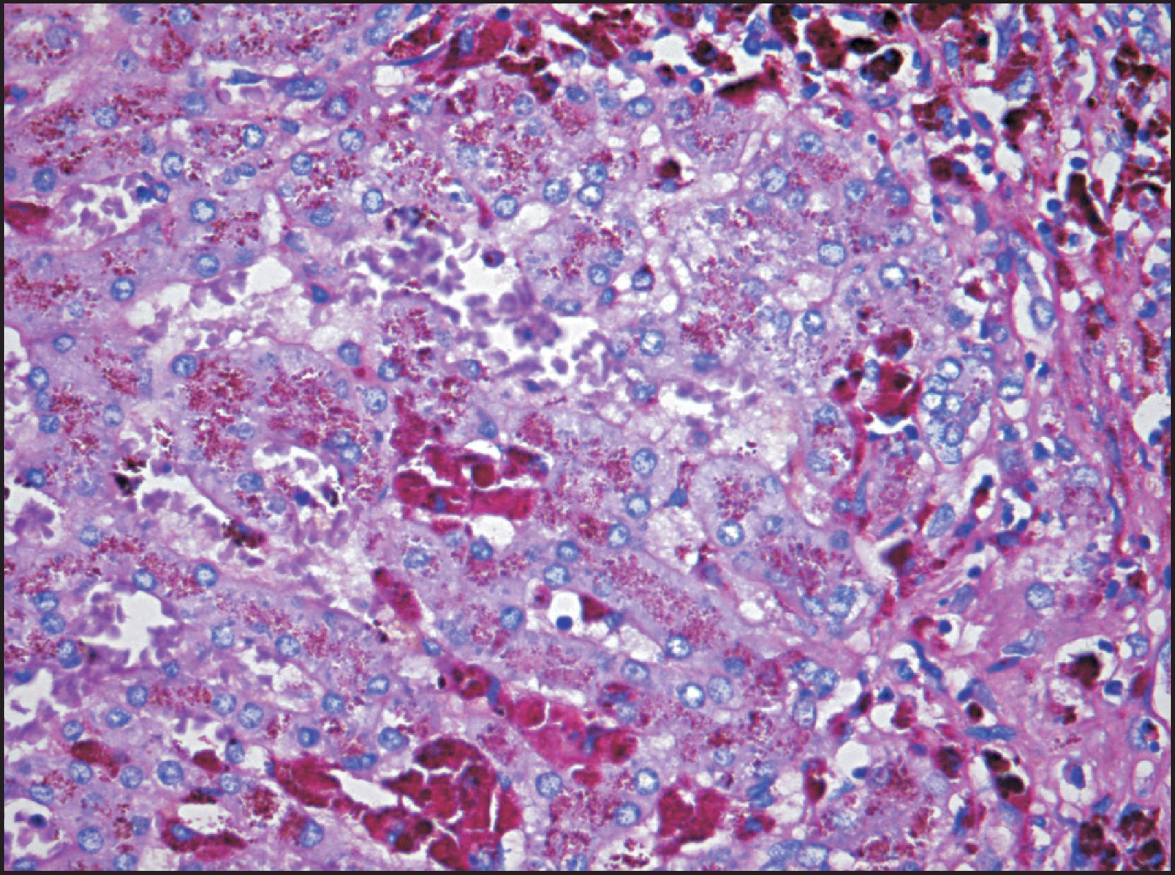 Figure 4.8, Male of 45 years confirmed to be homozygous for the C282Y mutation and with a history of alcohol abuse. Cirrhosis with grade 4 iron overload was confirmed histologically. Sideronecrosis is identified by large globules of haemosiderin associated with aggregates of heavily iron-laden Kupffer cells (Periodic acid-Schiff [PAS]-positive), both periportal and within the lobular parenchyma. (PAS stain.)