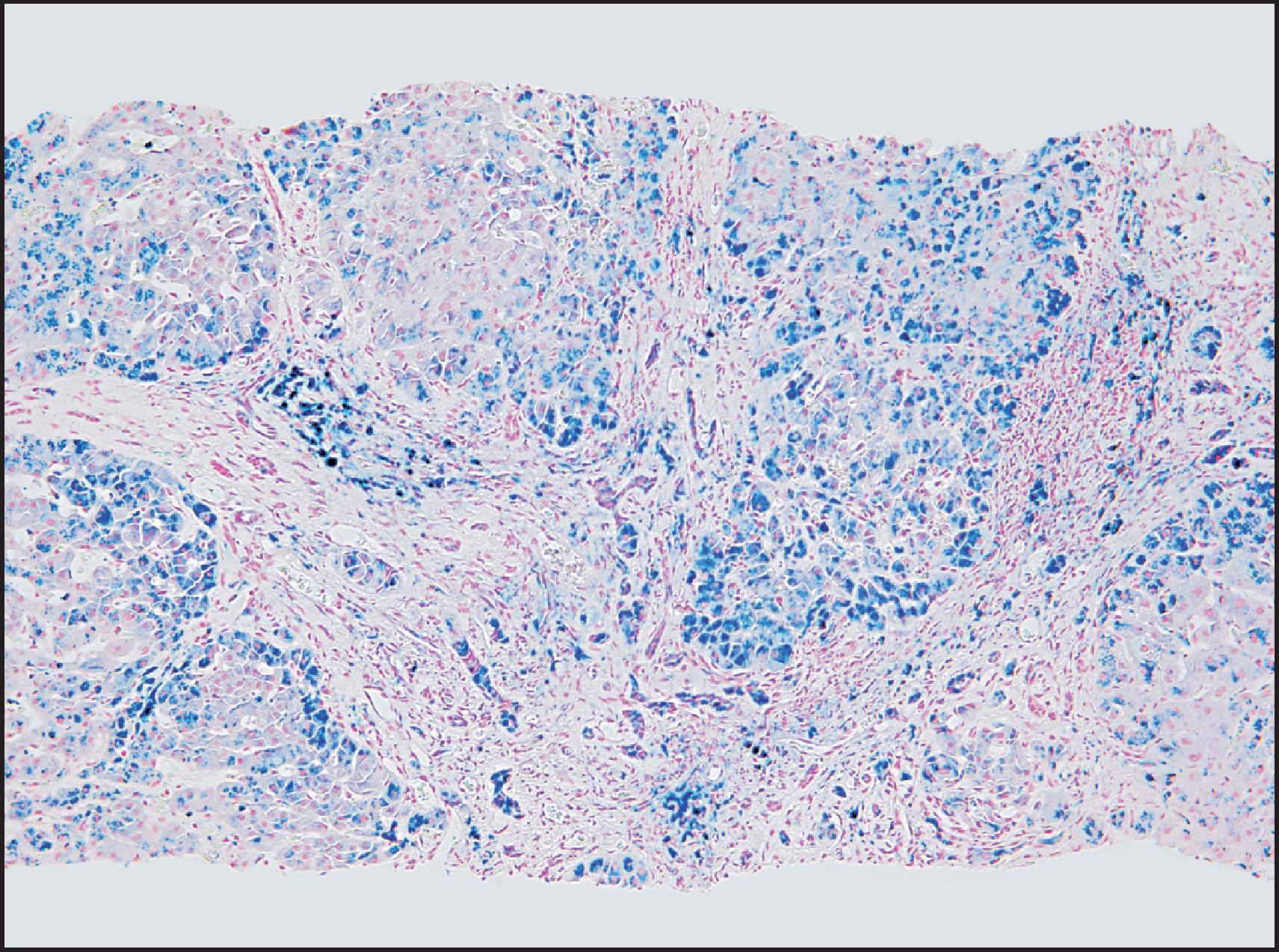 Figure 4.9, Patient with oesophageal varices and splenomegaly. Biopsy demonstrates established cirrhosis with haemosiderin deposition in hepatocytes, bile ducts, and portal macrophages. (Perls stain.)