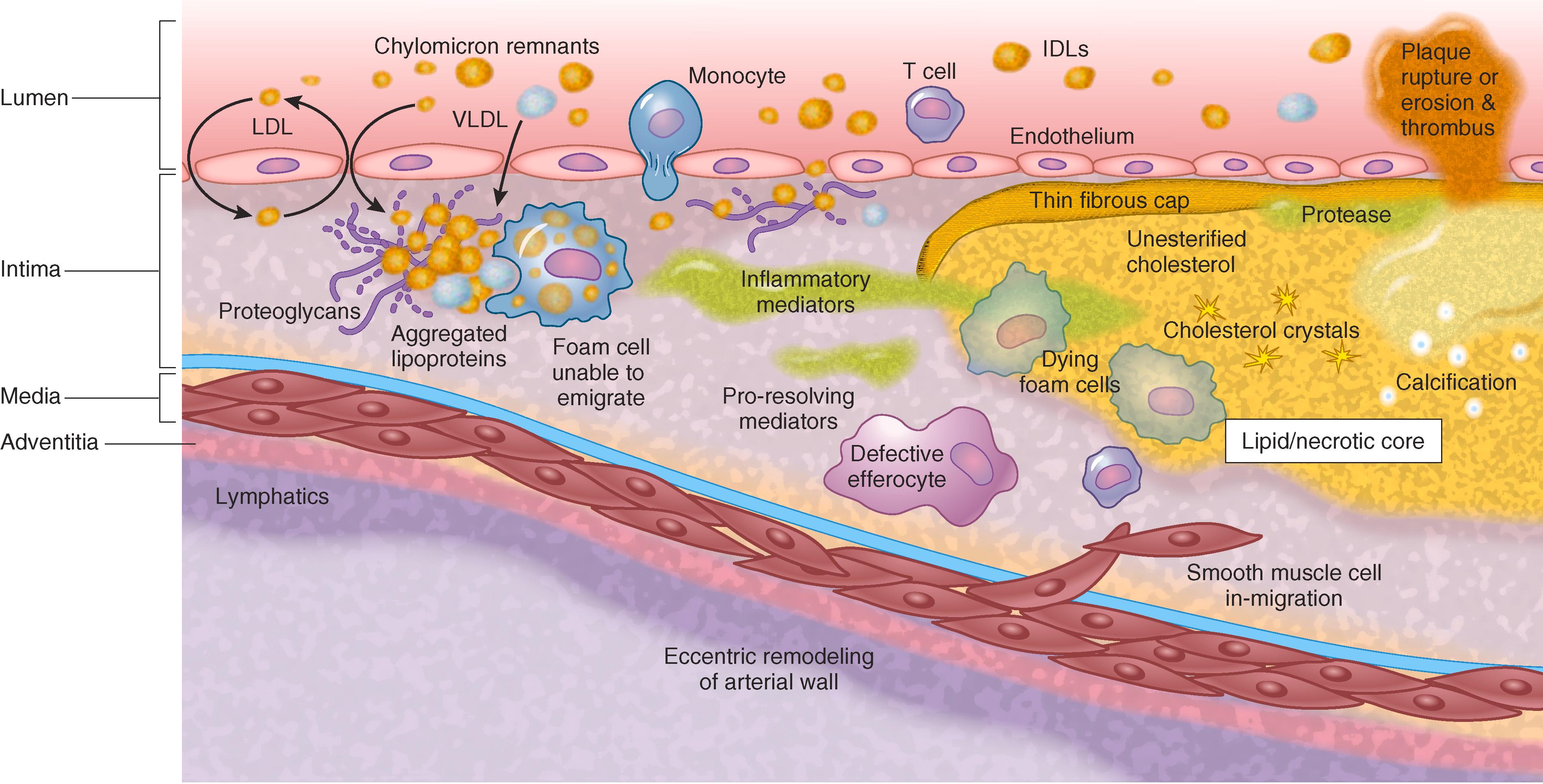 FIGURE 190-2, Apo B lipoprotein response-to-retention model of atherosclerosis initiation and progression.