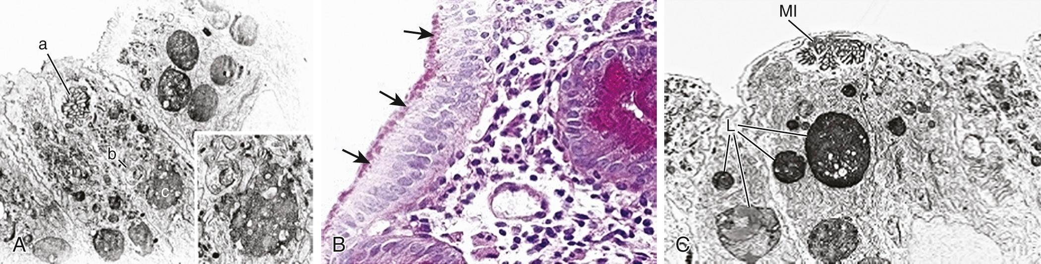 Fig. 364.7, Microvillus inclusion disease.