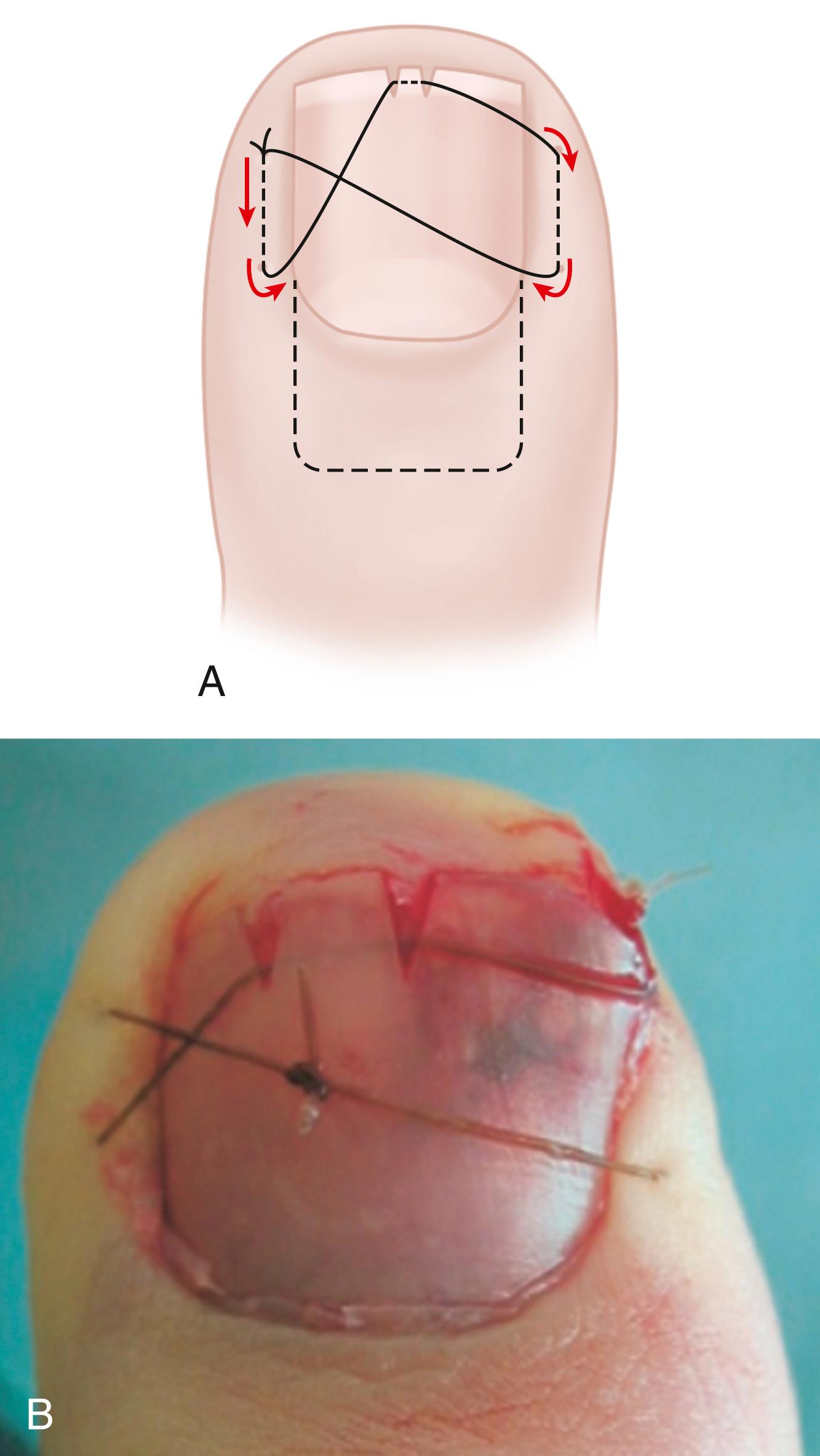 FIGURE 88.2, Transverse figure-of-eight suture for securing the nail.