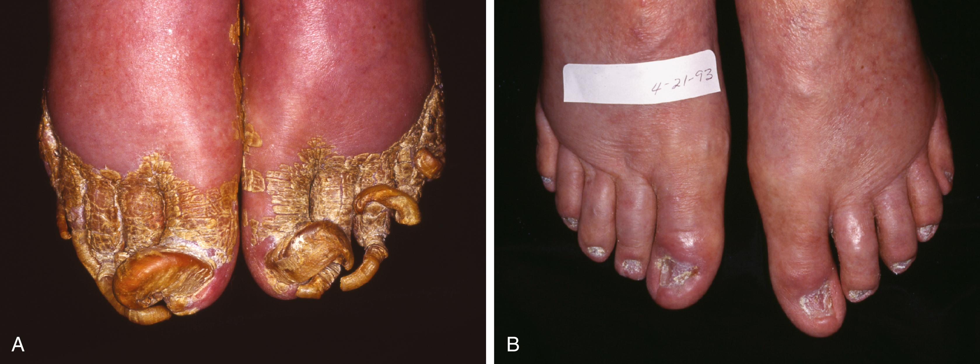 FIGURE 88.3, A, Onychomycosis. Ram’s horn nails in 90-year-old man. B, After nail reduction.