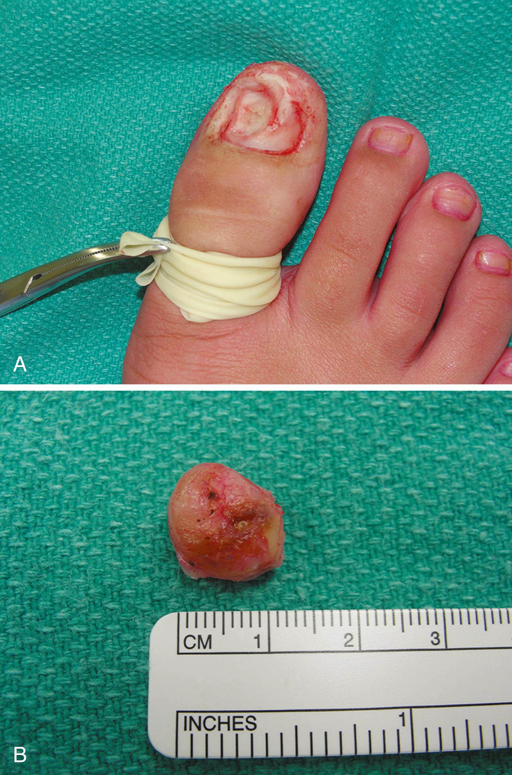 FIGURE 88.5, Marginal excision of subungual exostosis. A , Because lesion had invaded nail bed, making it unsalvageable, direct dorsal exostectomy was done. B , Osteocartilaginous lesion was marginally resected, and base of stalk was curetted, ronguered, and burred down to create “saucer-like” defect.