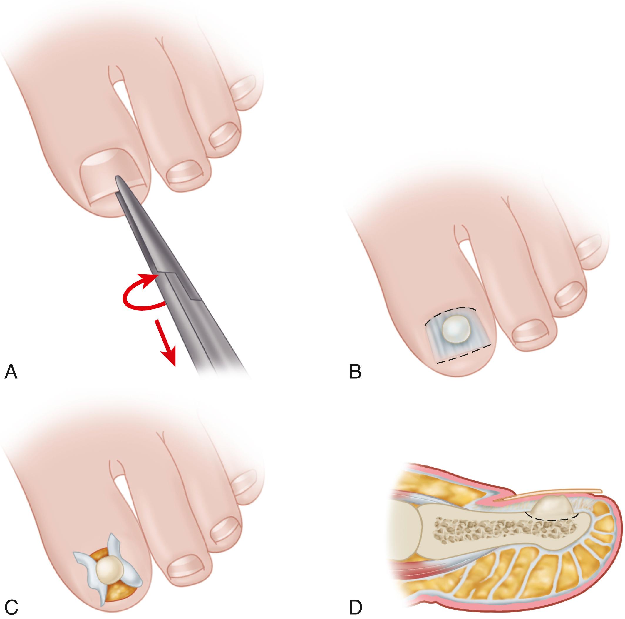 FIGURE 88.7, Surgical excision of subungual exostosis. A, Toenail is completely avulsed to expose exostosis. B, Longitudinal incision is made in nail bed, avoiding injury to nail matrix. C, Nail bed is reflected. D, Exostosis is excised with wide margins and nail bed is repaired. SEE TECHNIQUE 88.2 .