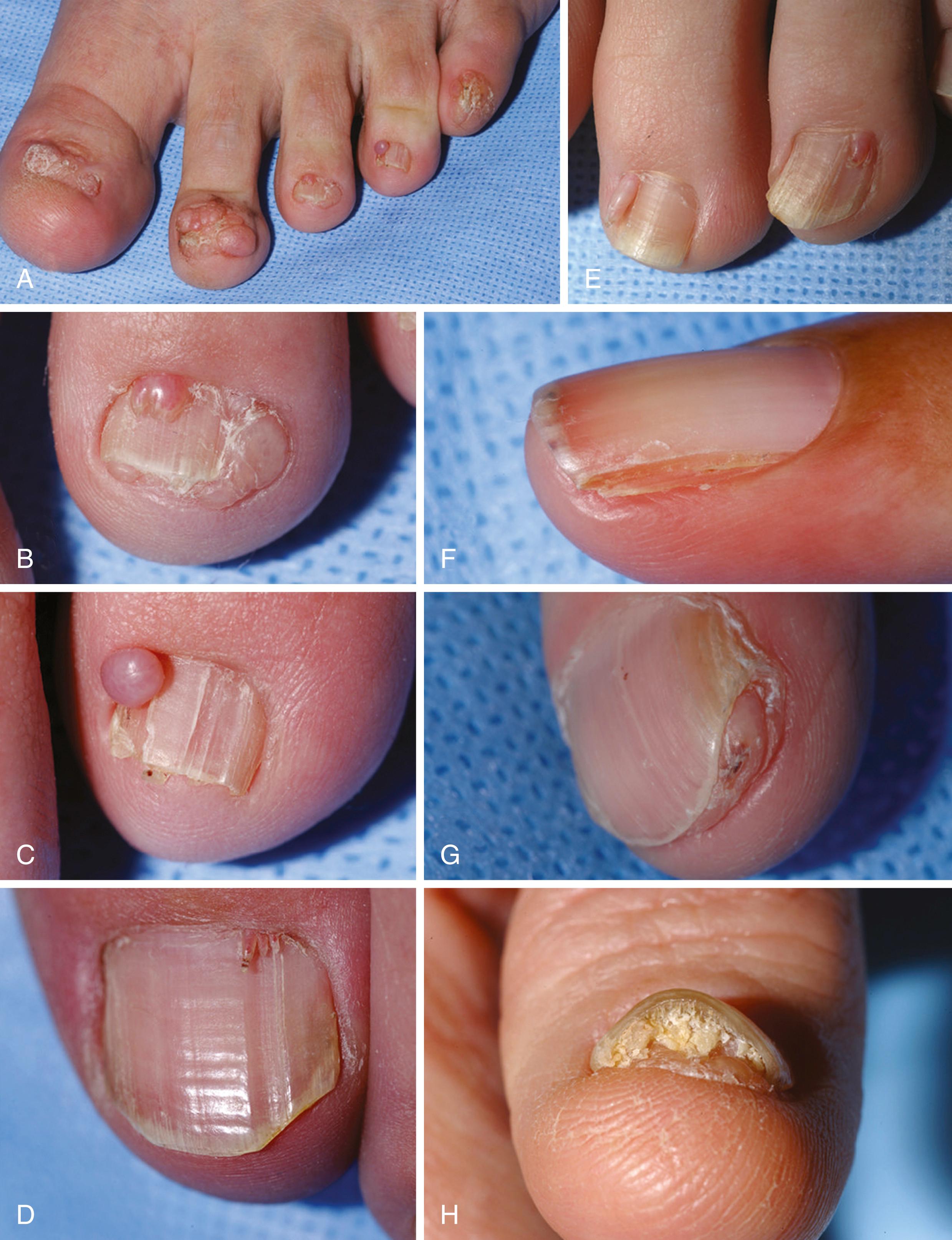 FIGURE 88.8, Periungual fibroma and subungual fibroma in tuberous sclerosis complex. A , Ungual fibromas involving all nails. B , Third toe shows clove-like periungual fibroma, nail-like periungual fibroma, and subungual fibroma. C , Fourth toe shows globoid periungual fibroma and longitudinal groove without visible fibroma. D , Three fusiform periungual fibromas filling one longitudinal groove. E , Vermiform periungual fibromas. F , Longitudinal groove without visible fibroma. G , Subungual fibroma protruding from under nail plate. H , Elevation of nail plate from subungual fibroma.