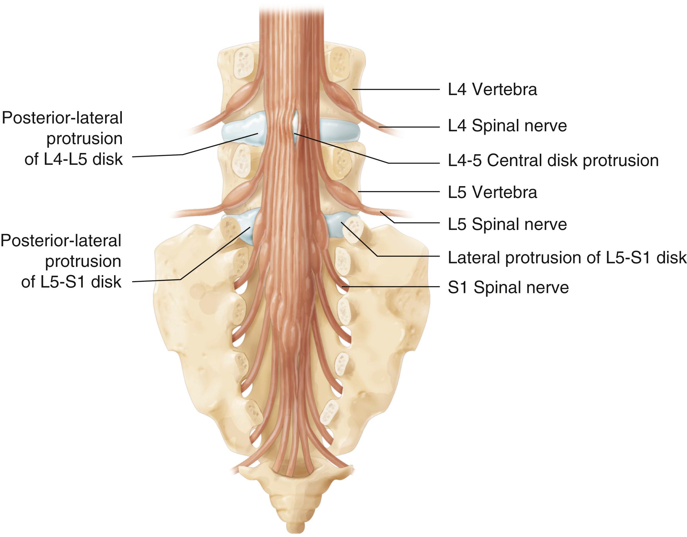 Fig. 105.3, Dorsal View of Lower Lumbar Spine and Sacrum, Showing the Different Types of Herniations and How Different Roots and the Cauda Equina Can Be Compressed.