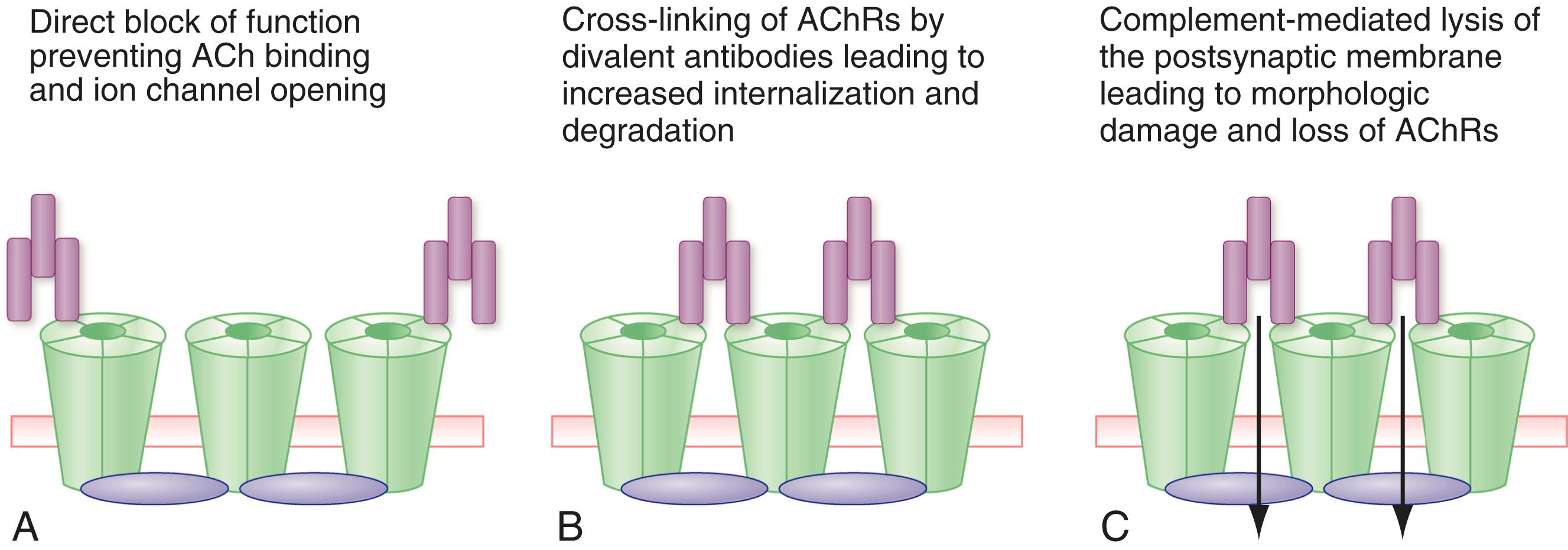 E-FIGURE 390-2, Effects of antibodies on the acetylcholine (ACh) receptor (AChR).