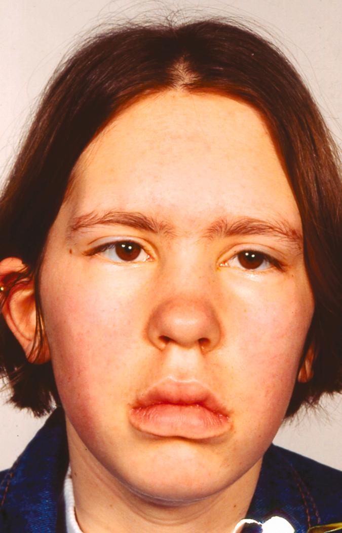 FIGURE 390-1, Marked ocular and facial muscle weakness in a young female with myasthenia gravis.