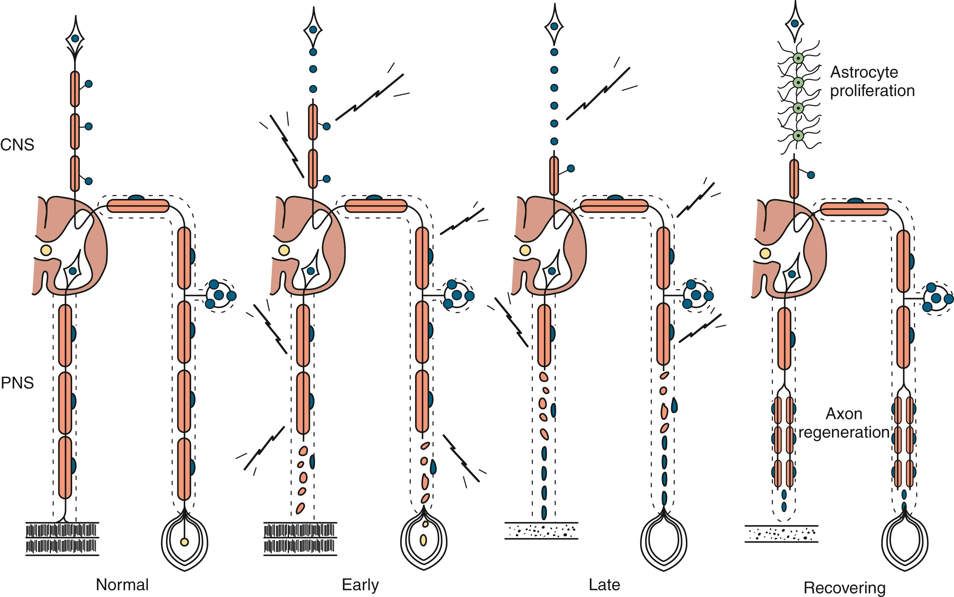 Fig. 106.1, Diagram of the Main Pathological Events of Distal Axonal Degeneration or Axonopathy.