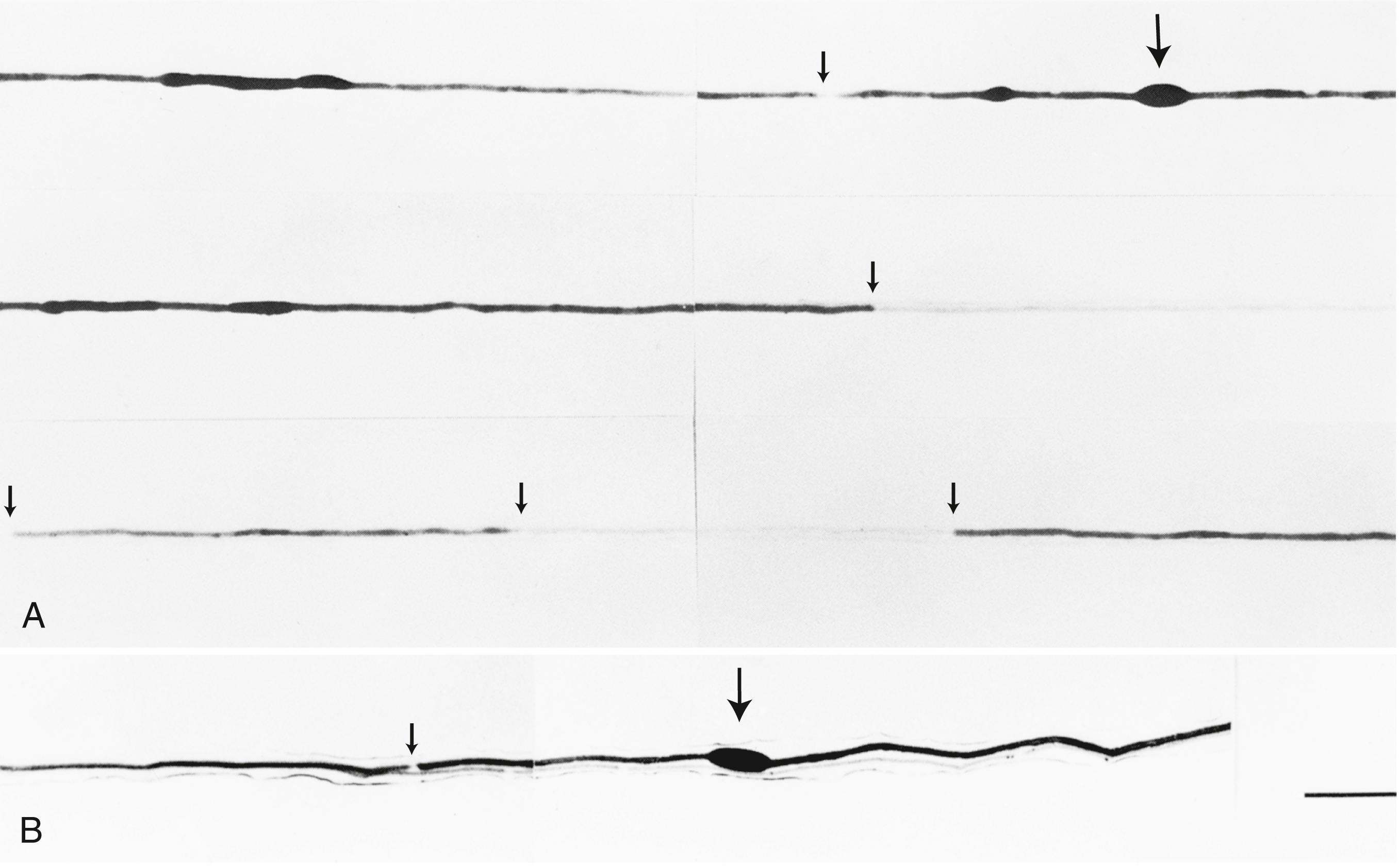 Fig. 106.11, Single teased nerve fibers from a patient with hereditary liability to pressure palsies, showing examples of focal sausage-shaped enlargements of the myelin sheath (large arrows) in two fibers ( A, B ). Fiber A shows thinly remyelinated internodes. Successive nodes of Ranvier (thin arrows) can be followed from left to right. (Bar = 100 μm.)