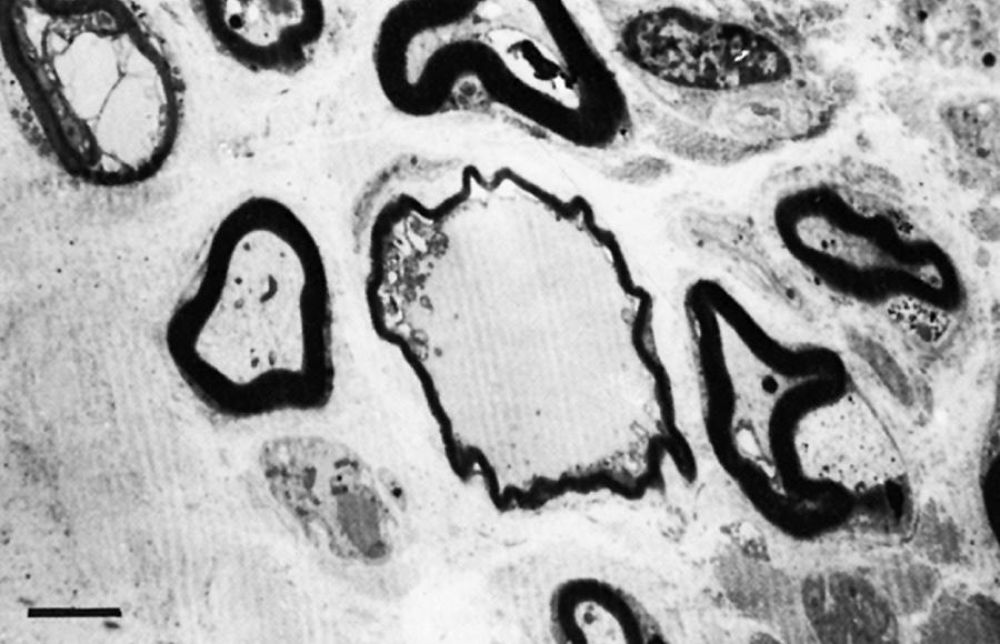 eFig. 16.12, Giant Axonal Neuropathy.