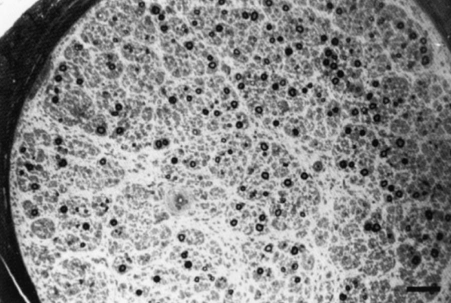 eFig. 106.13, Semi-thin transverse section of sural nerve from a patient with hereditary sensory and autonomic neuropathy type I. Note loss of large and small myelinated fibers. (Toluidine blue; bar = 50 μm.)