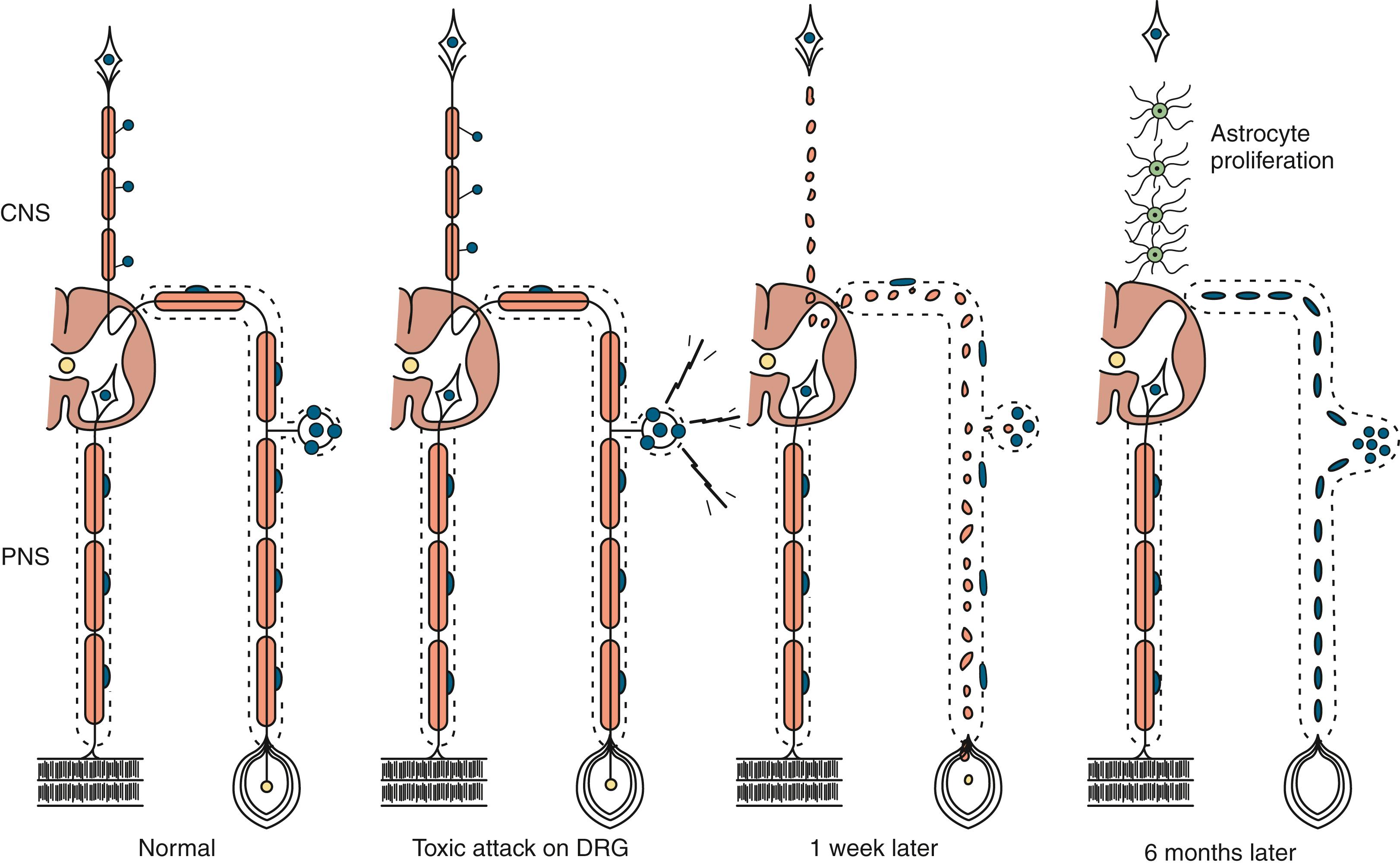 Fig. 106.2, Diagram of the Main Pathological Events of a Sensory Neuropathy or Gangliopathy.