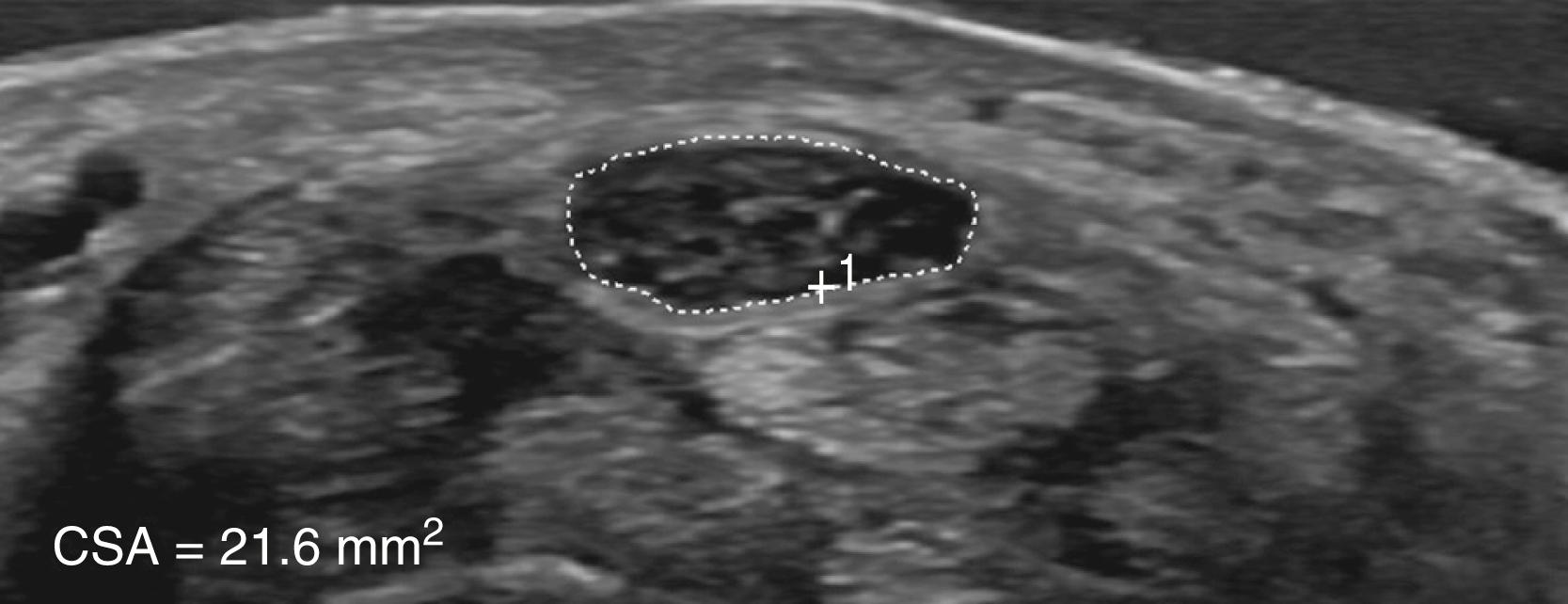 Fig. 106.7, Ultrasound of the median nerve at the wrist showing a hypoechoic and enlarged median nerve at the carpal tunnel inlet with a cross-sectional area (CSA) measuring 21.6 mm 2 (normal < 10–13 mm)